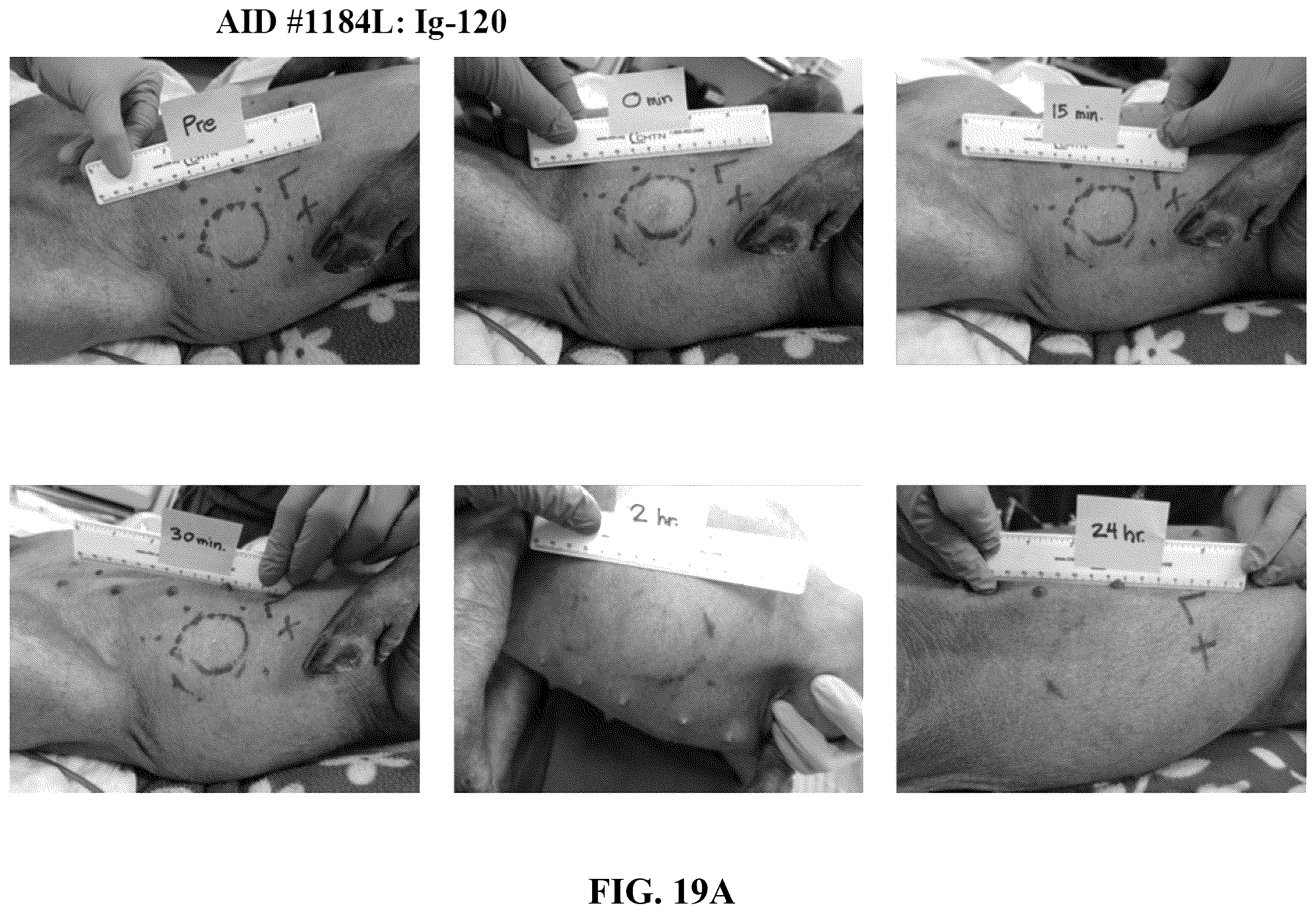 Patent US12551539 Figure 17 – Hyaluronidase enzyme formulations for high volume administration