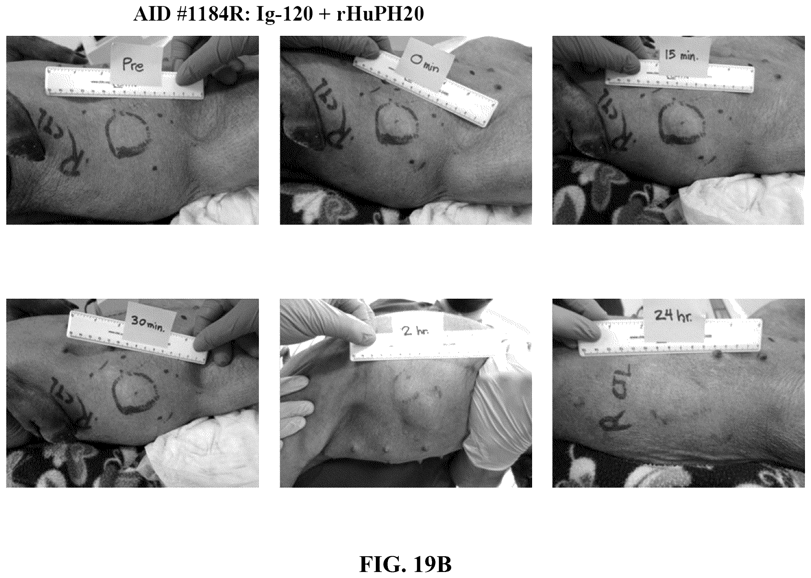 Patent US12551539 Figure 18 – Hyaluronidase enzyme formulations for high volume administration