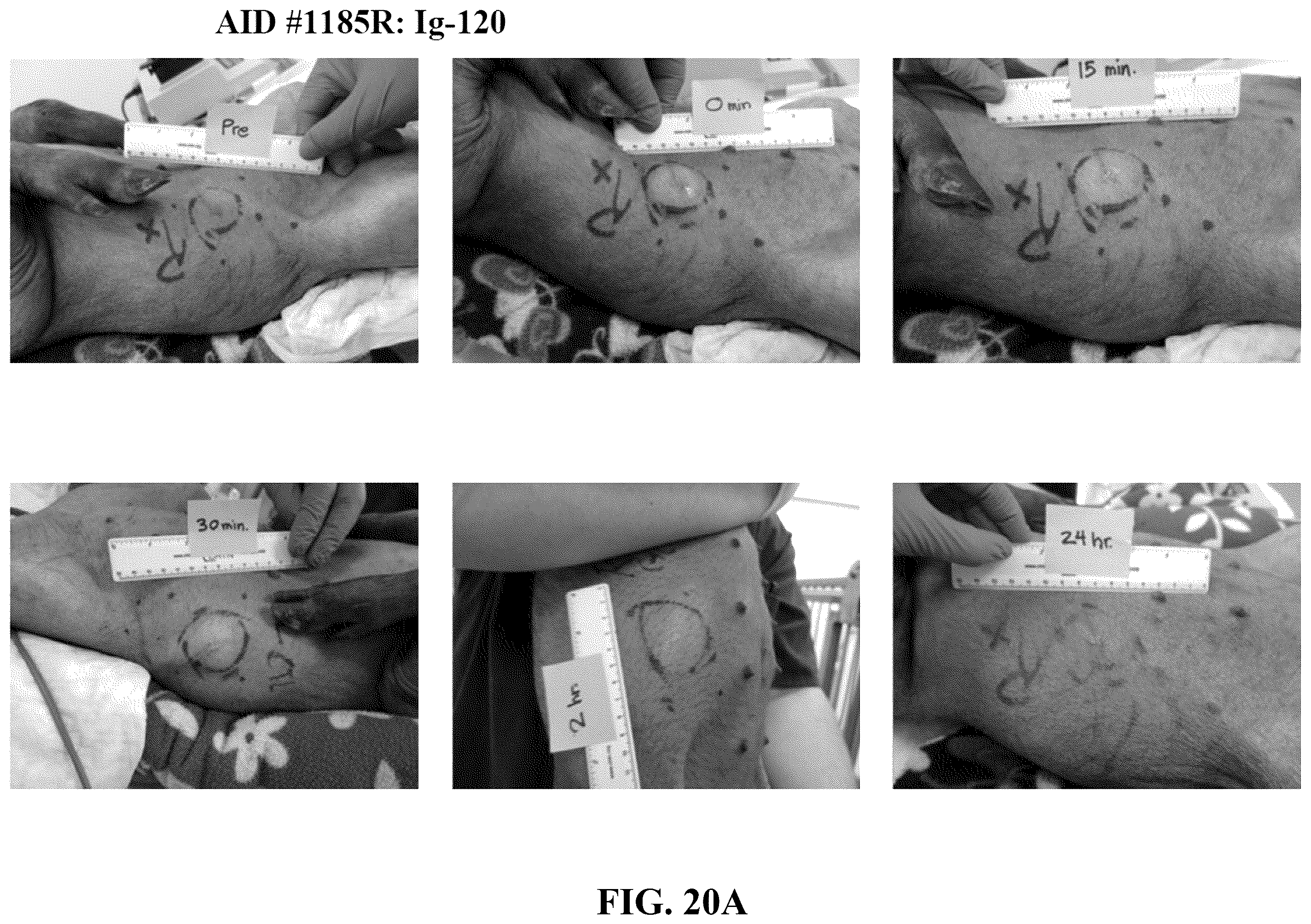 Patent US12551539 Figure 19 – Hyaluronidase enzyme formulations for high volume administration