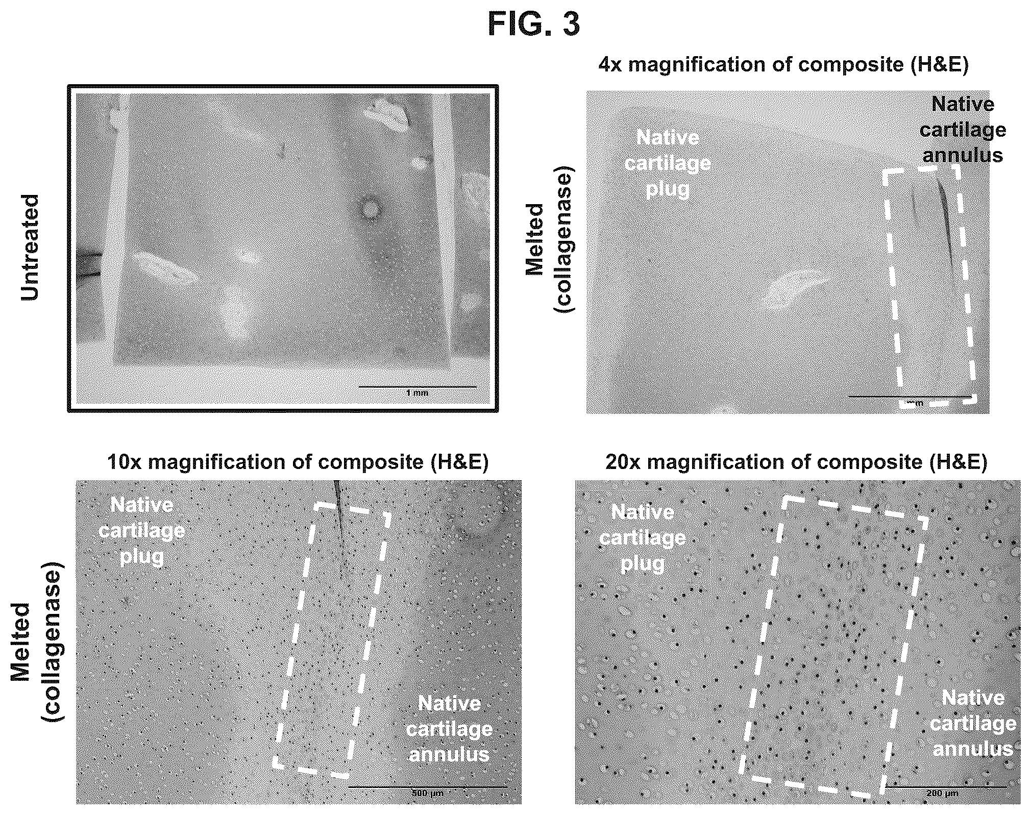 Patent US12551599 Figure 2 – Melt-and-meld approach to repair tissue defects