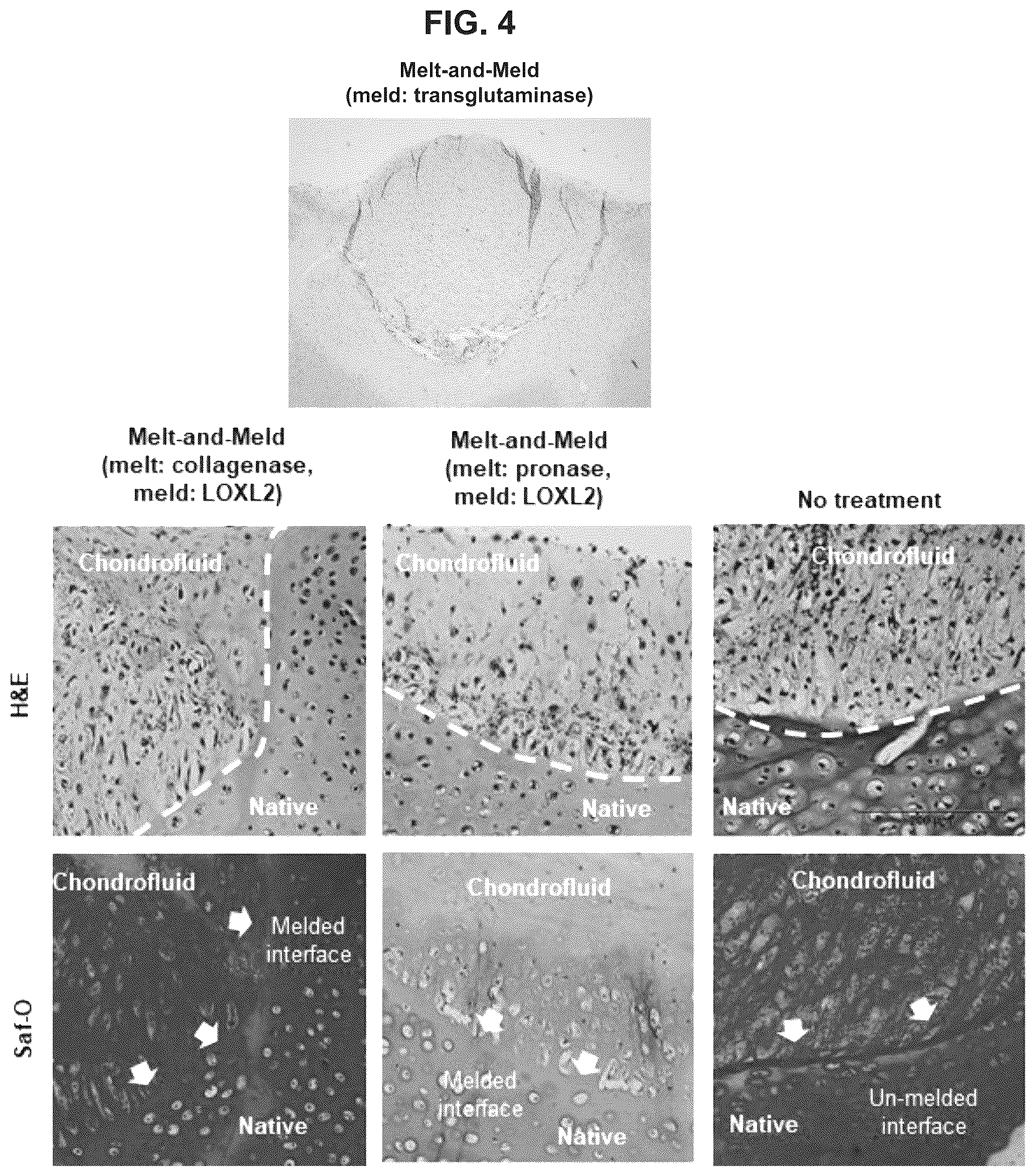 Patent US12551599 Figure 3 – Melt-and-meld approach to repair tissue defects