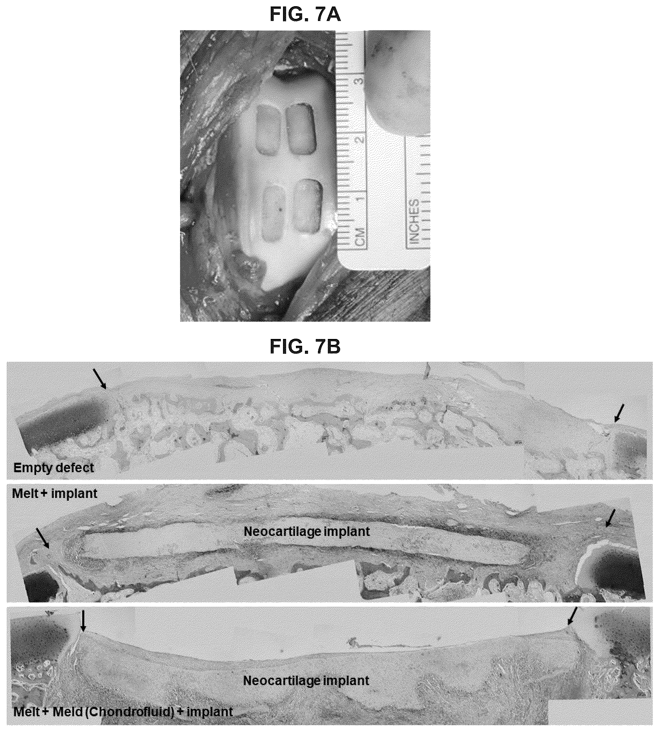Patent US12551599 Figure 5 – Melt-and-meld approach to repair tissue defects