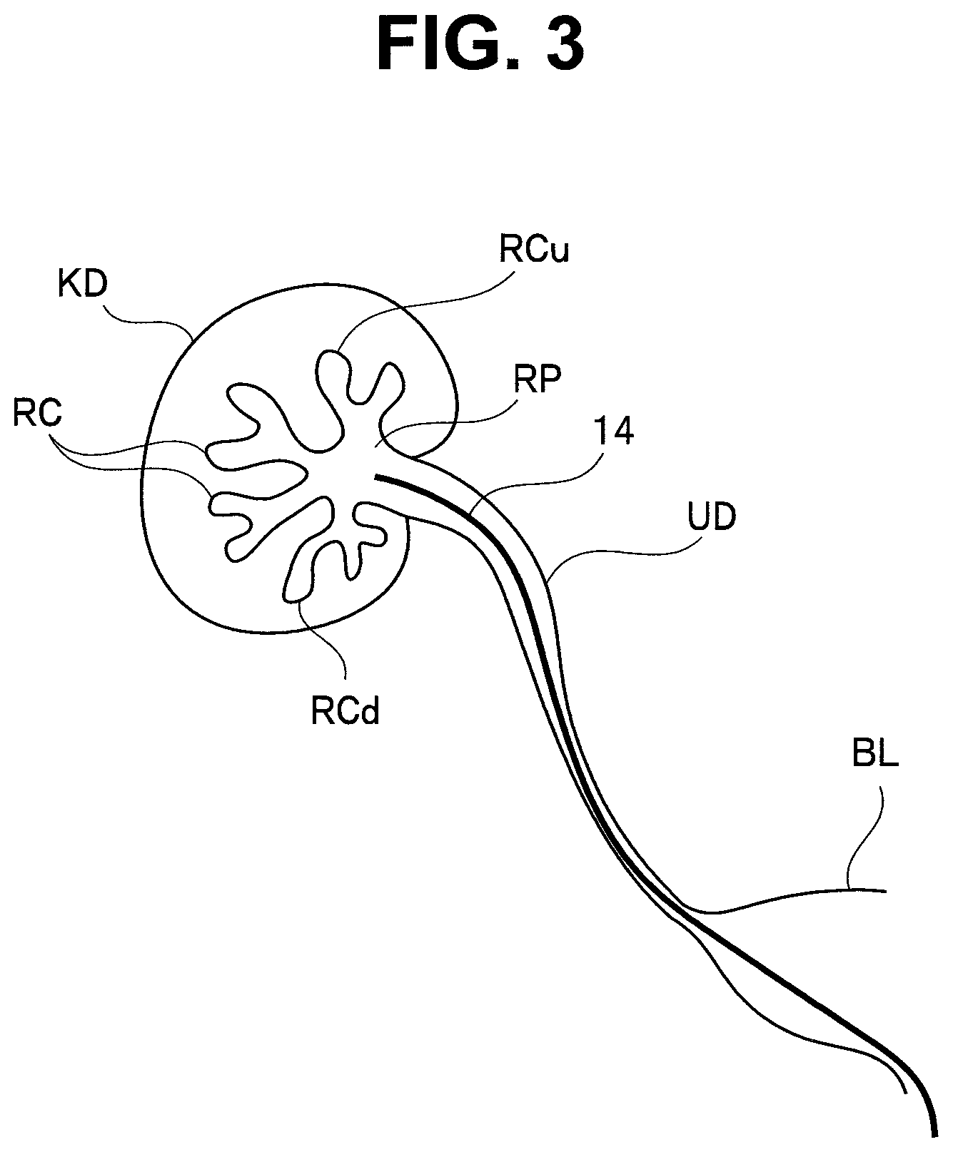 Patent US12551609 Figure 3 – Medical solid-matter collection apparatus and medical suction system