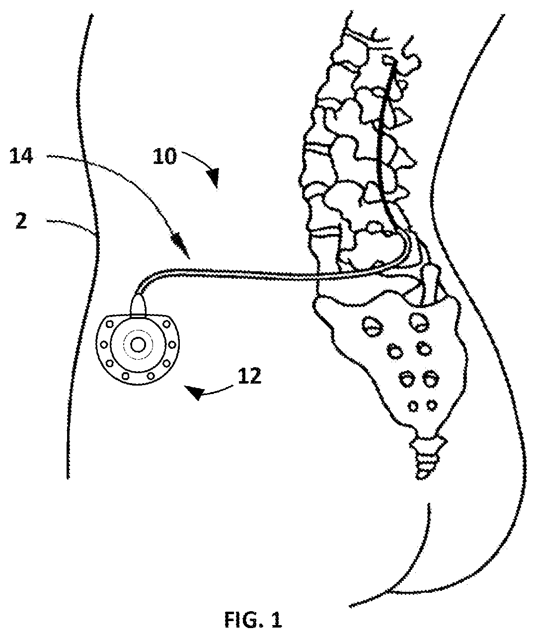 Patent US12551613 Figure 1 – Implantable drug delivery port