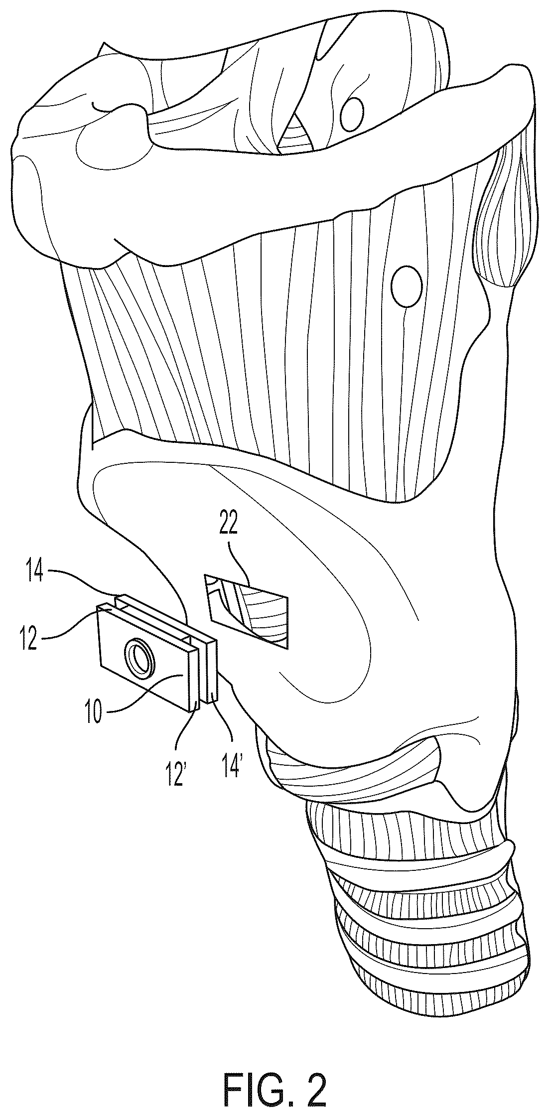 Patent US12551616 Figure 2 – Internal laryngeal muscle injection tool