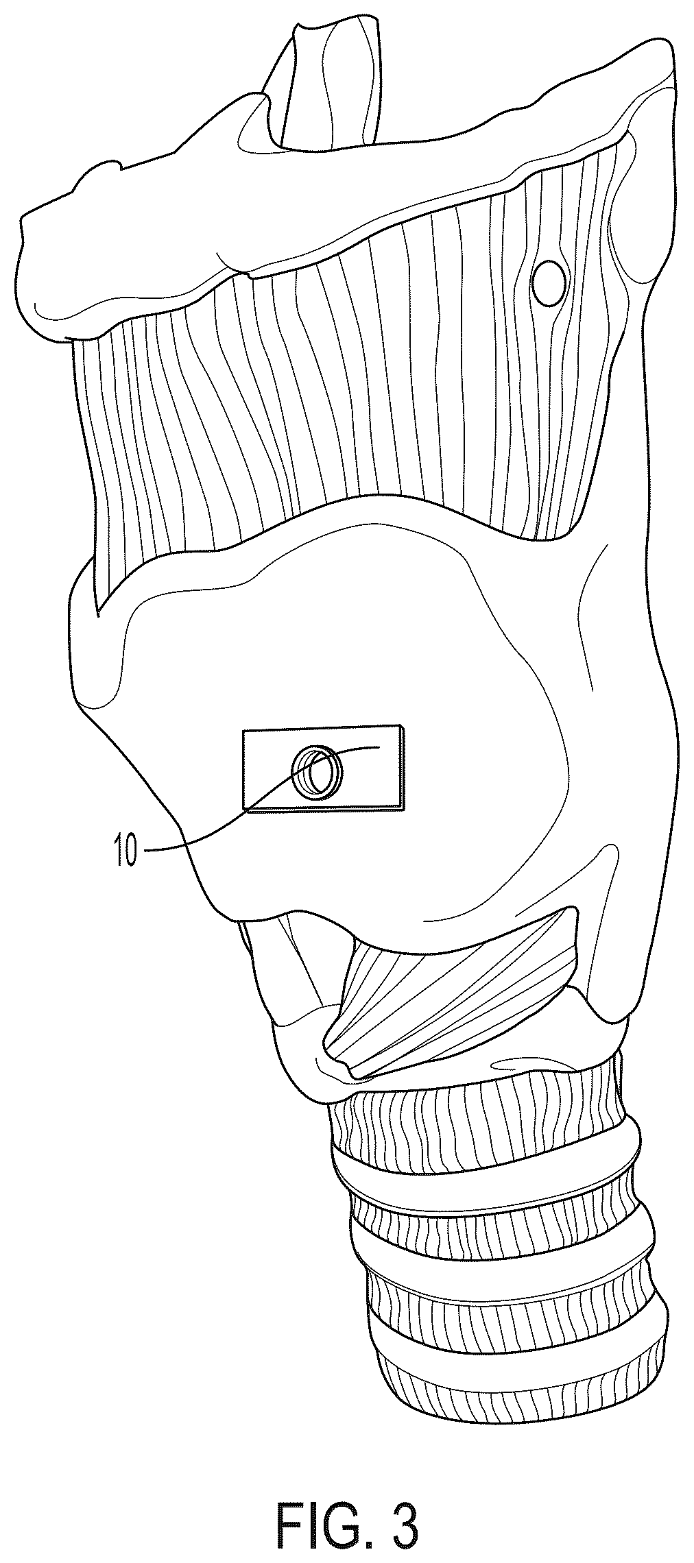 Patent US12551616 Figure 3 – Internal laryngeal muscle injection tool