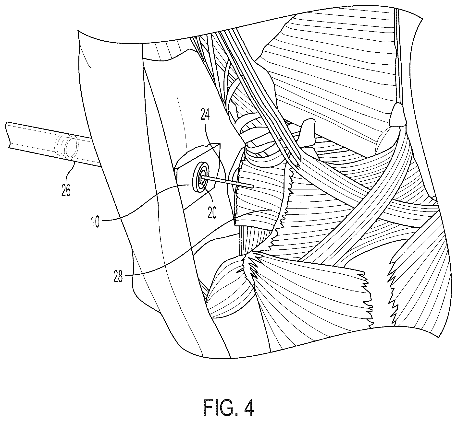 Patent US12551616 Figure 4 – Internal laryngeal muscle injection tool
