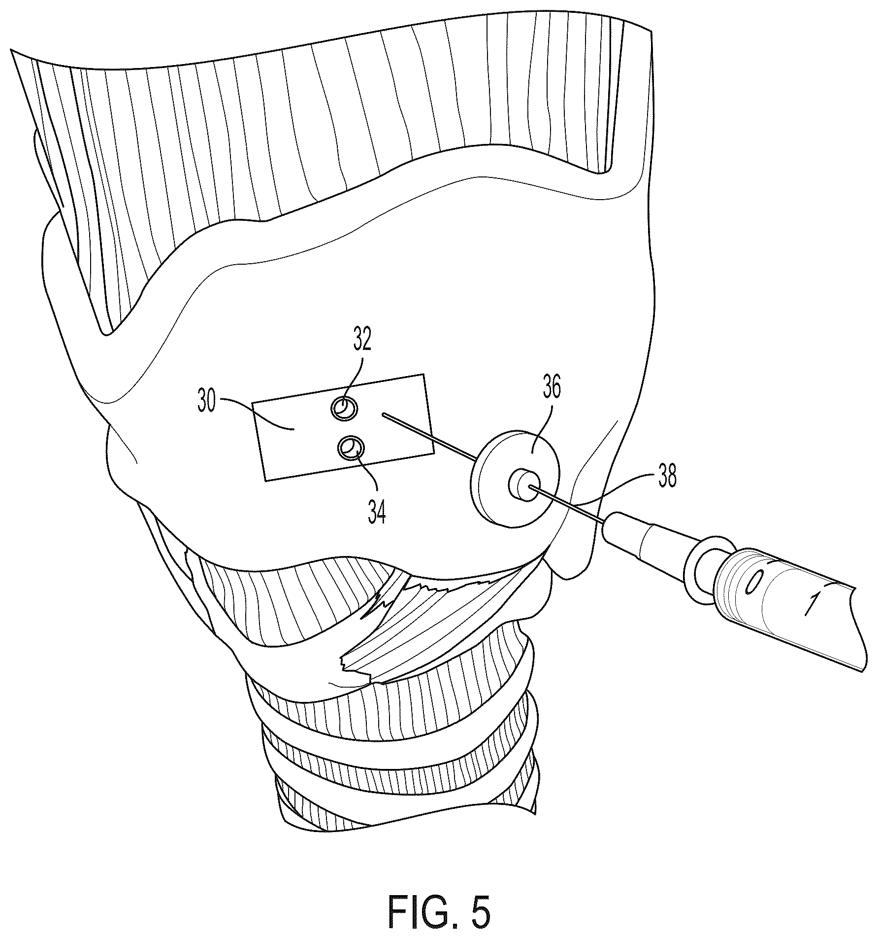 Patent US12551616 Figure 5 – Internal laryngeal muscle injection tool
