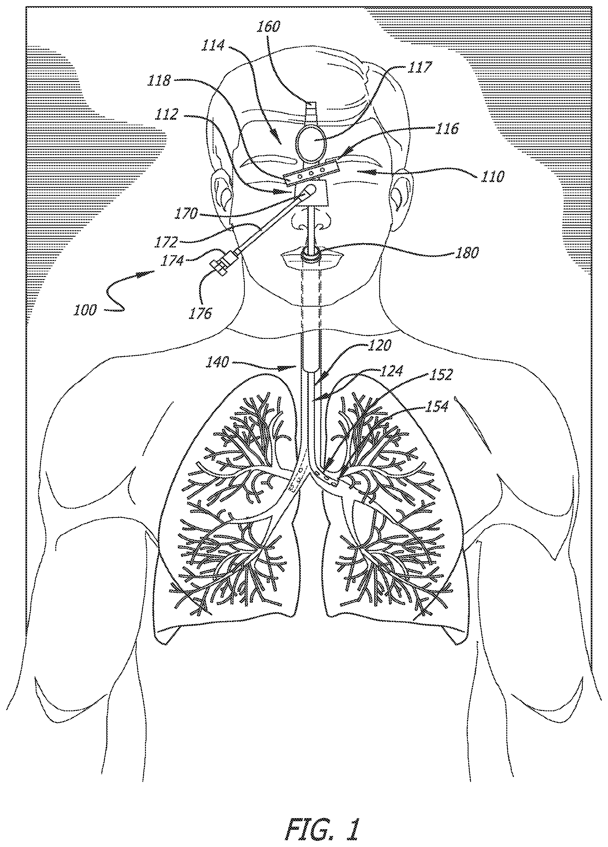 Patent US12551644 Figure 1 – Endobronchial suctioning device and medical suctioning system for intubated patients