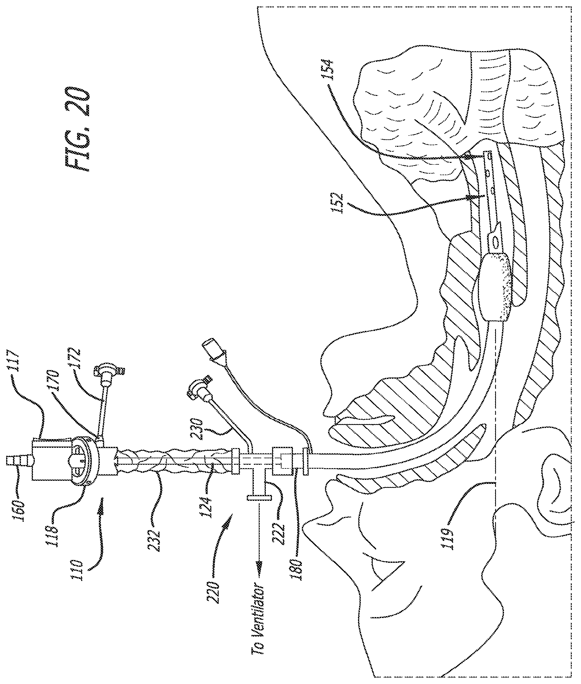 Patent US12551644 Figure 15 – Endobronchial suctioning device and medical suctioning system for intubated patients