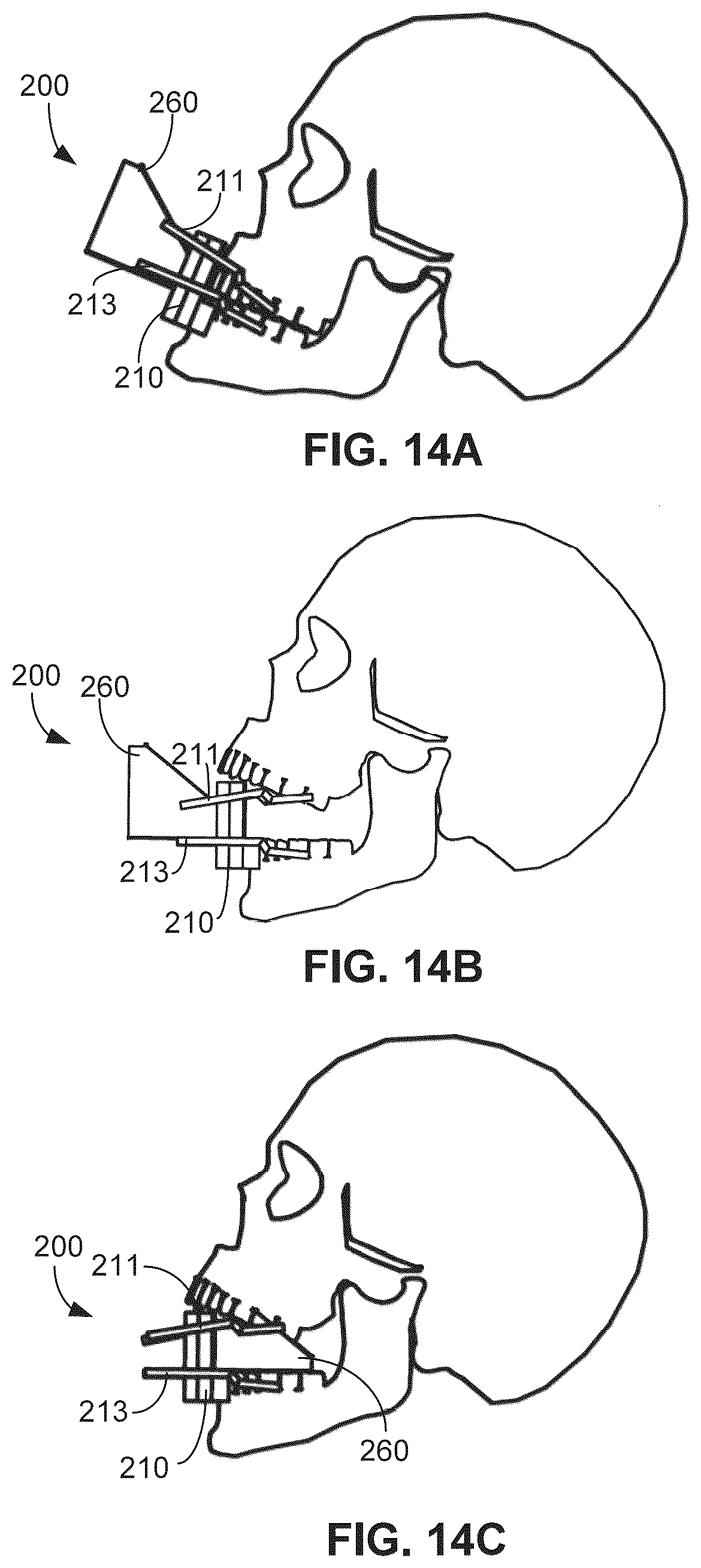 Patent US12551646 Figure 11 – Mouthpiece