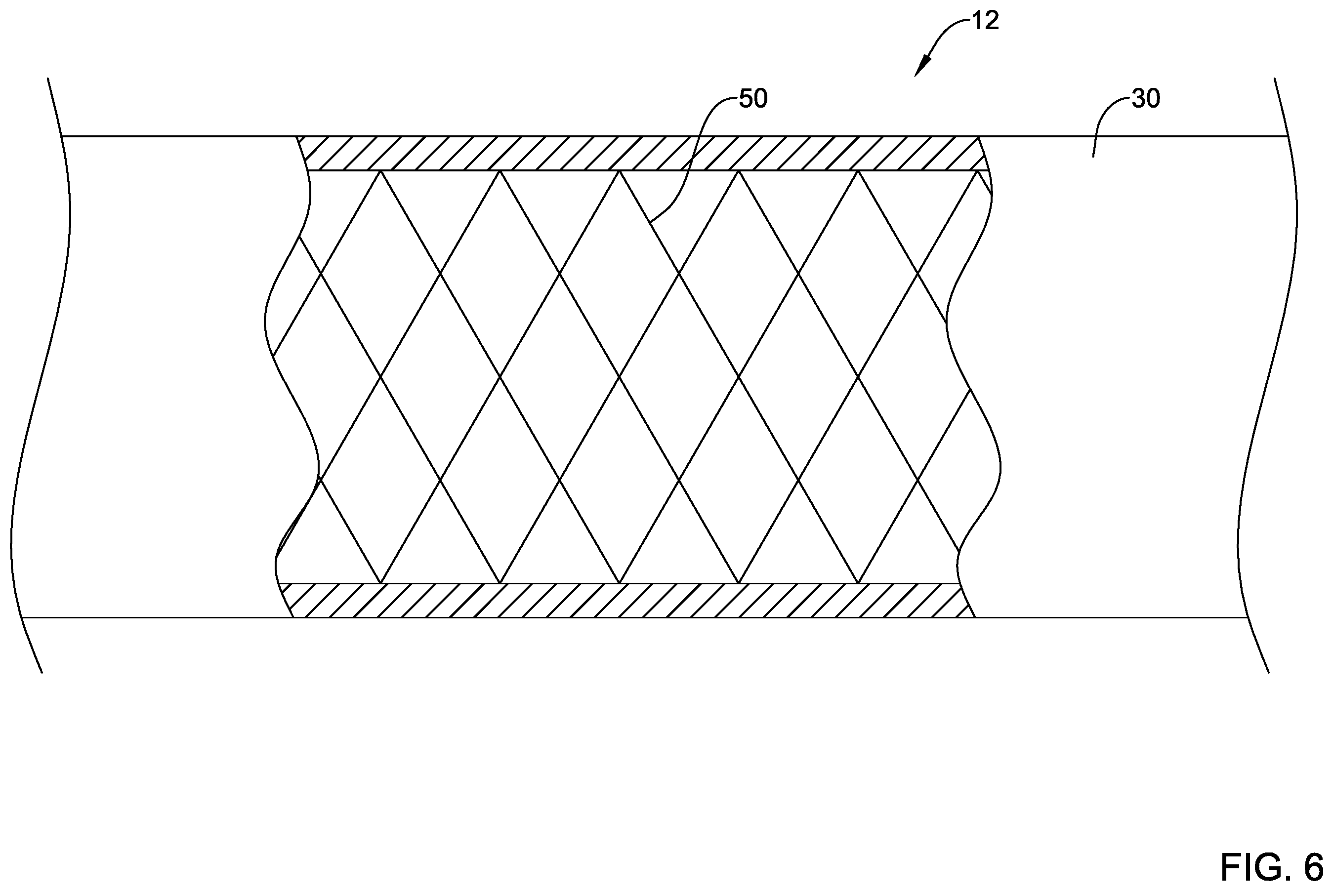 Patent US12551654 Figure 6 – Compression resistant sheath