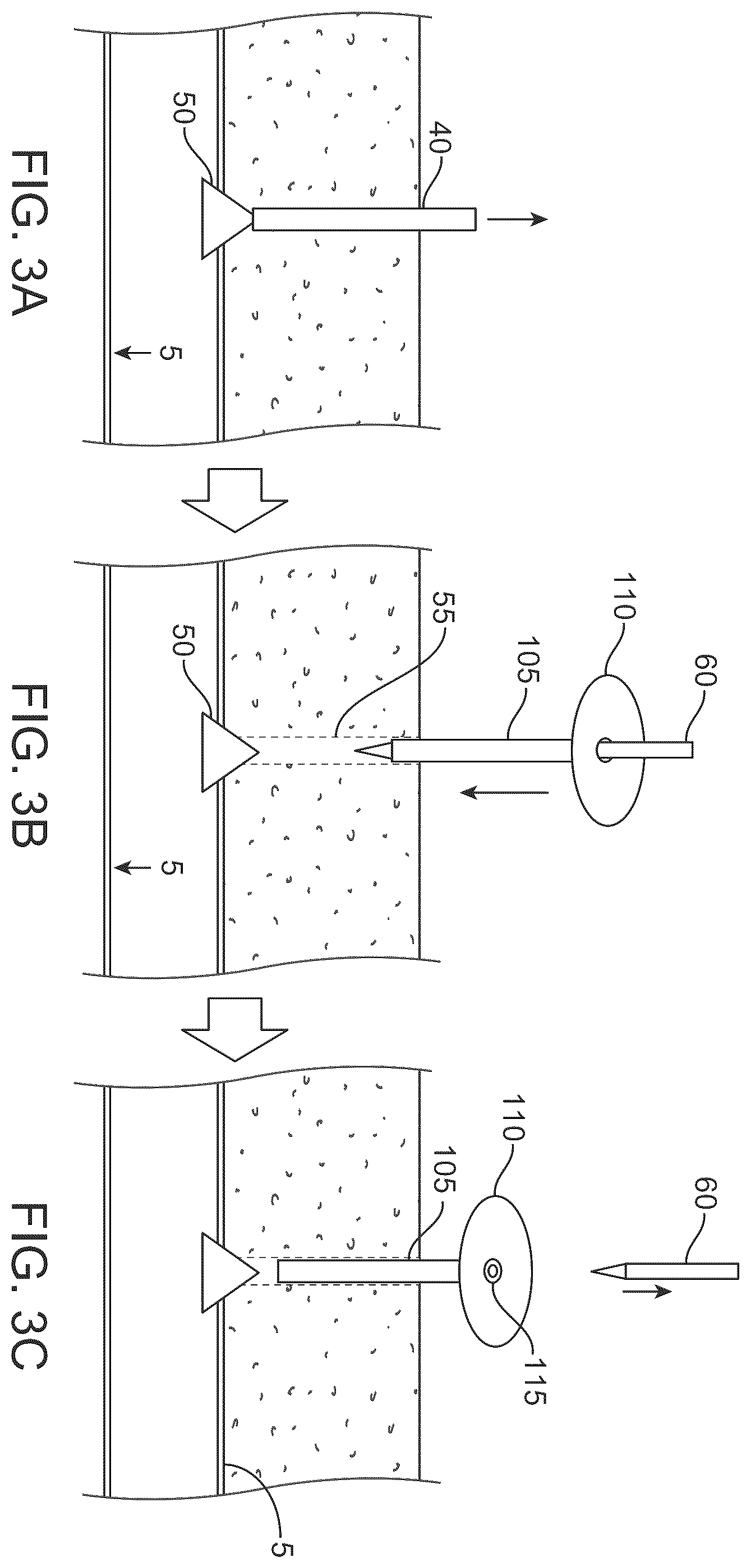 Patent US12551655 Figure 4 – Detection and pressure relief for percutaneous closure of a vessel