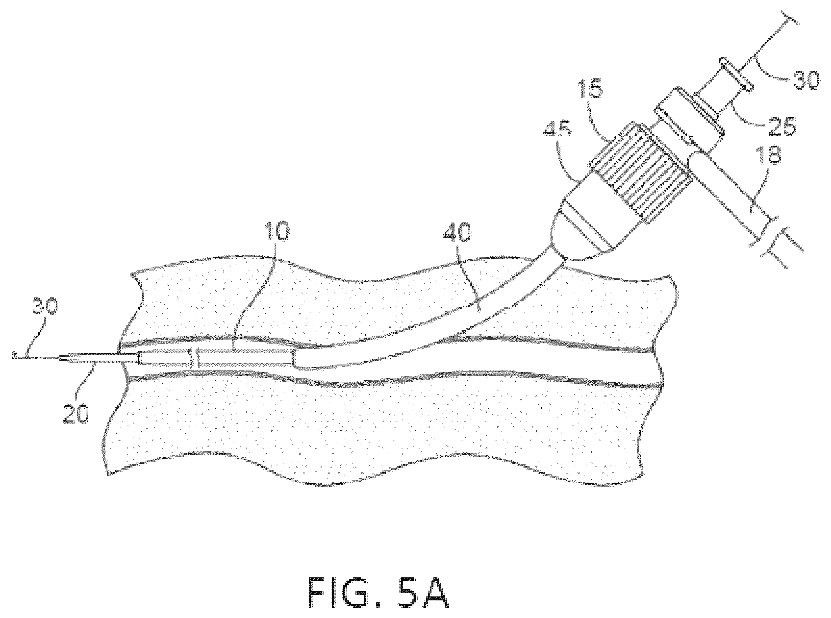 Patent US12551655 Figure 6 – Detection and pressure relief for percutaneous closure of a vessel