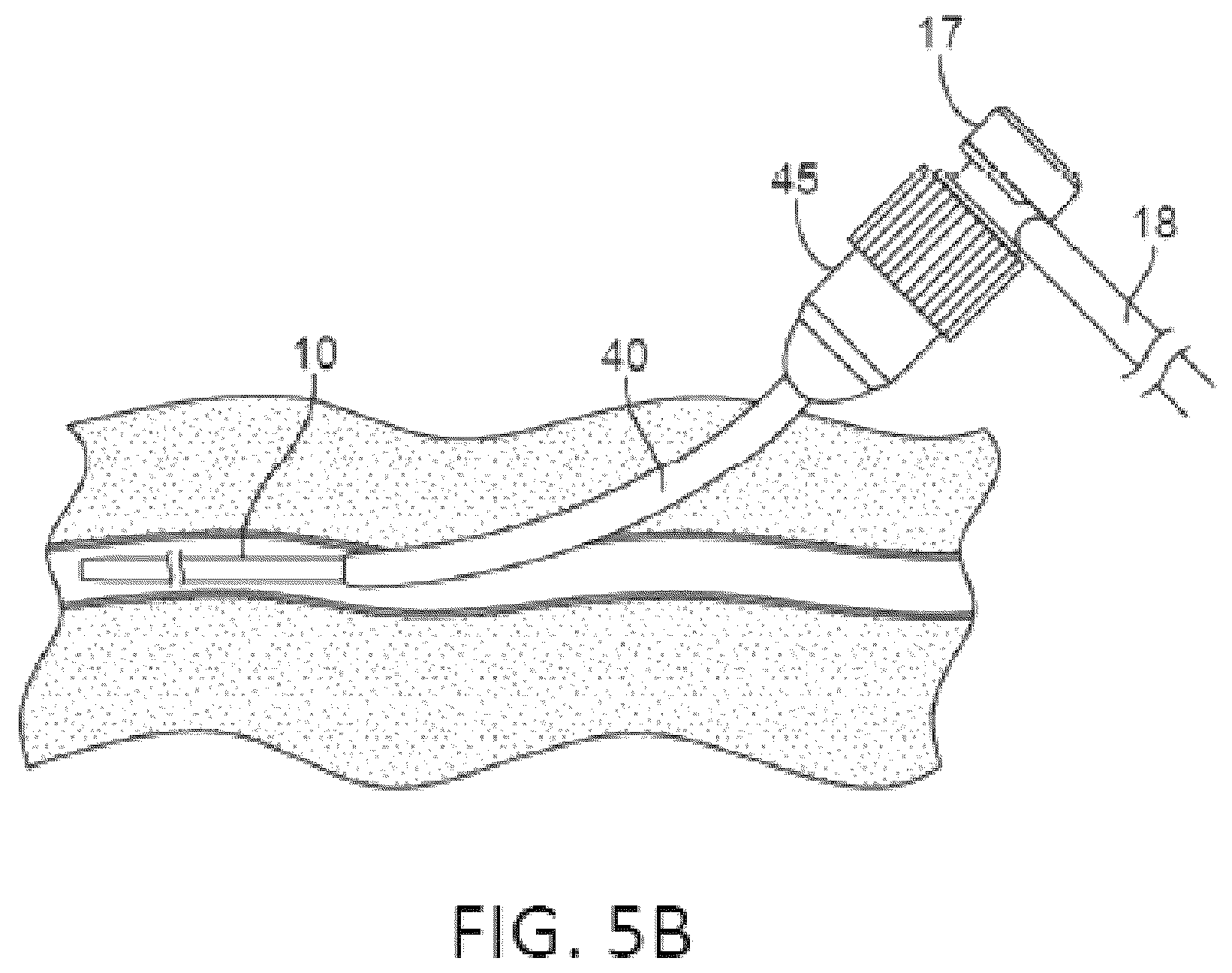 Patent US12551655 Figure 7 – Detection and pressure relief for percutaneous closure of a vessel