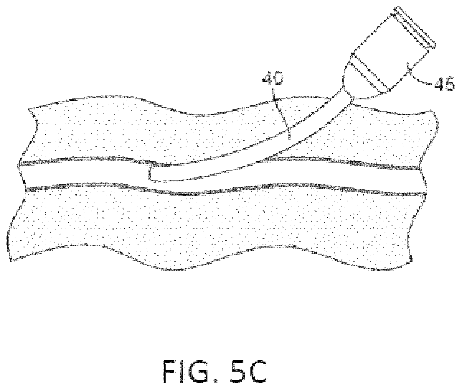 Patent US12551655 Figure 8 – Detection and pressure relief for percutaneous closure of a vessel