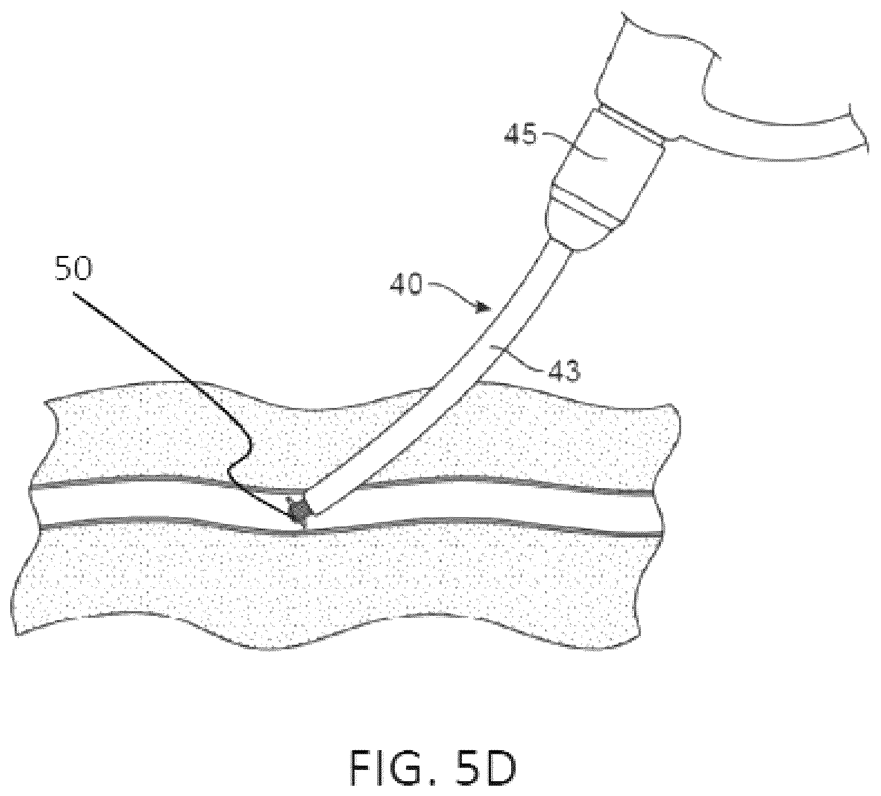 Patent US12551655 Figure 9 – Detection and pressure relief for percutaneous closure of a vessel