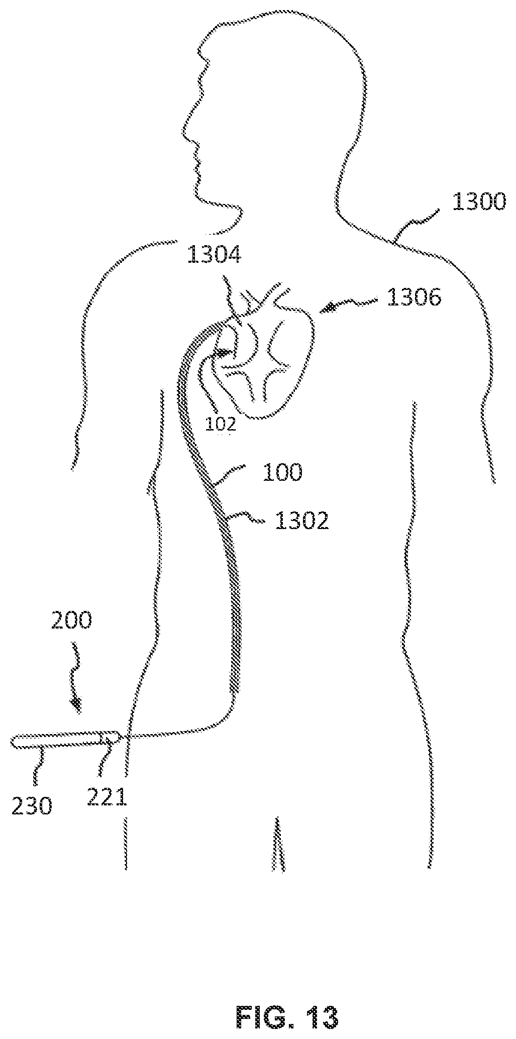 Patent US12551658 Figure 18 – Steerable introducer with slide block divider