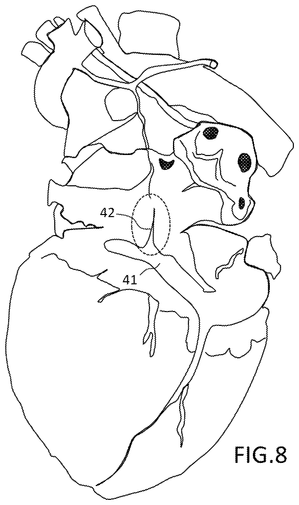 Patent US12551667 Figure 5 – Catheter, inflatable balloon for a catheter