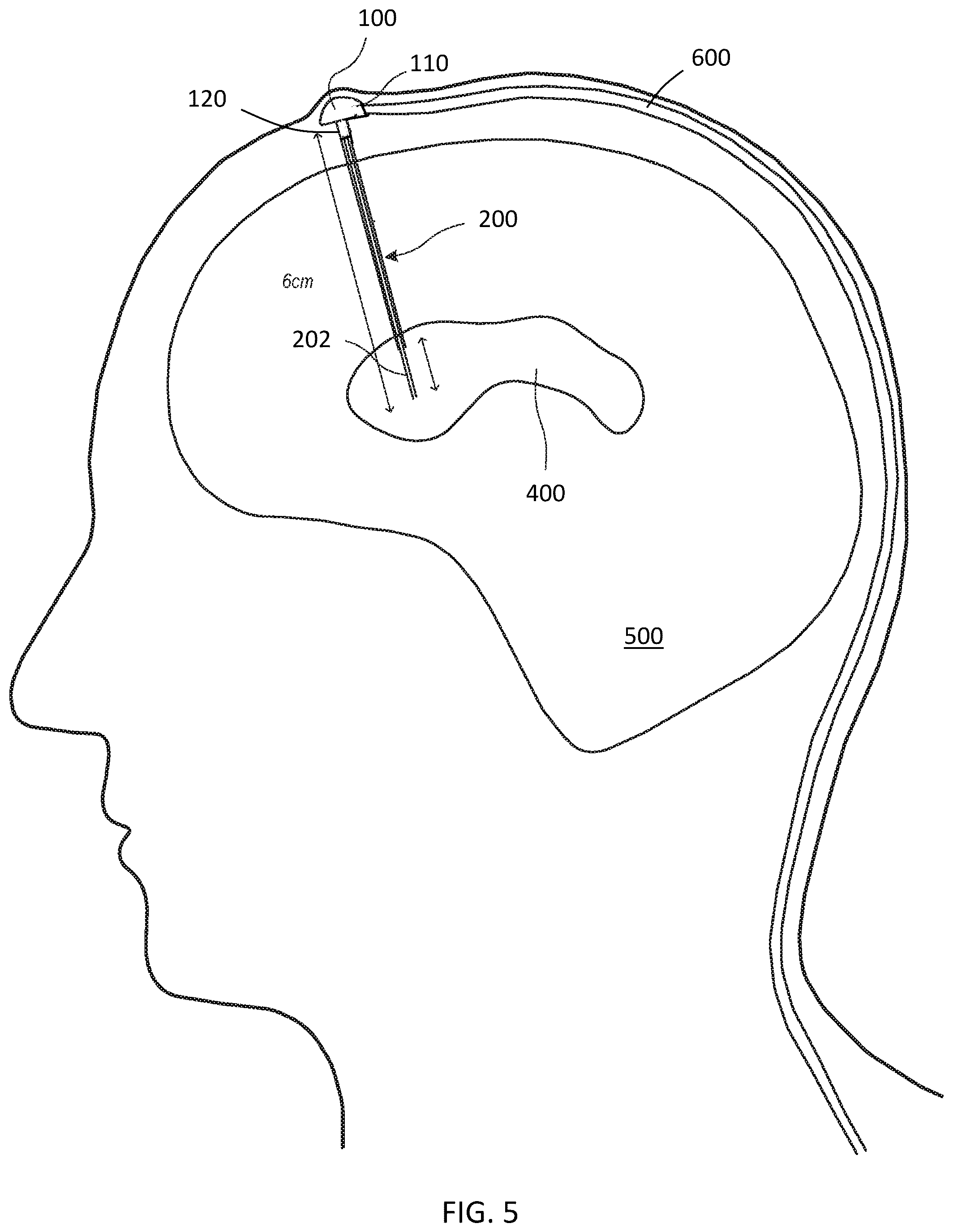 Patent US12551669 Figure 2 – Medical system including two access ports