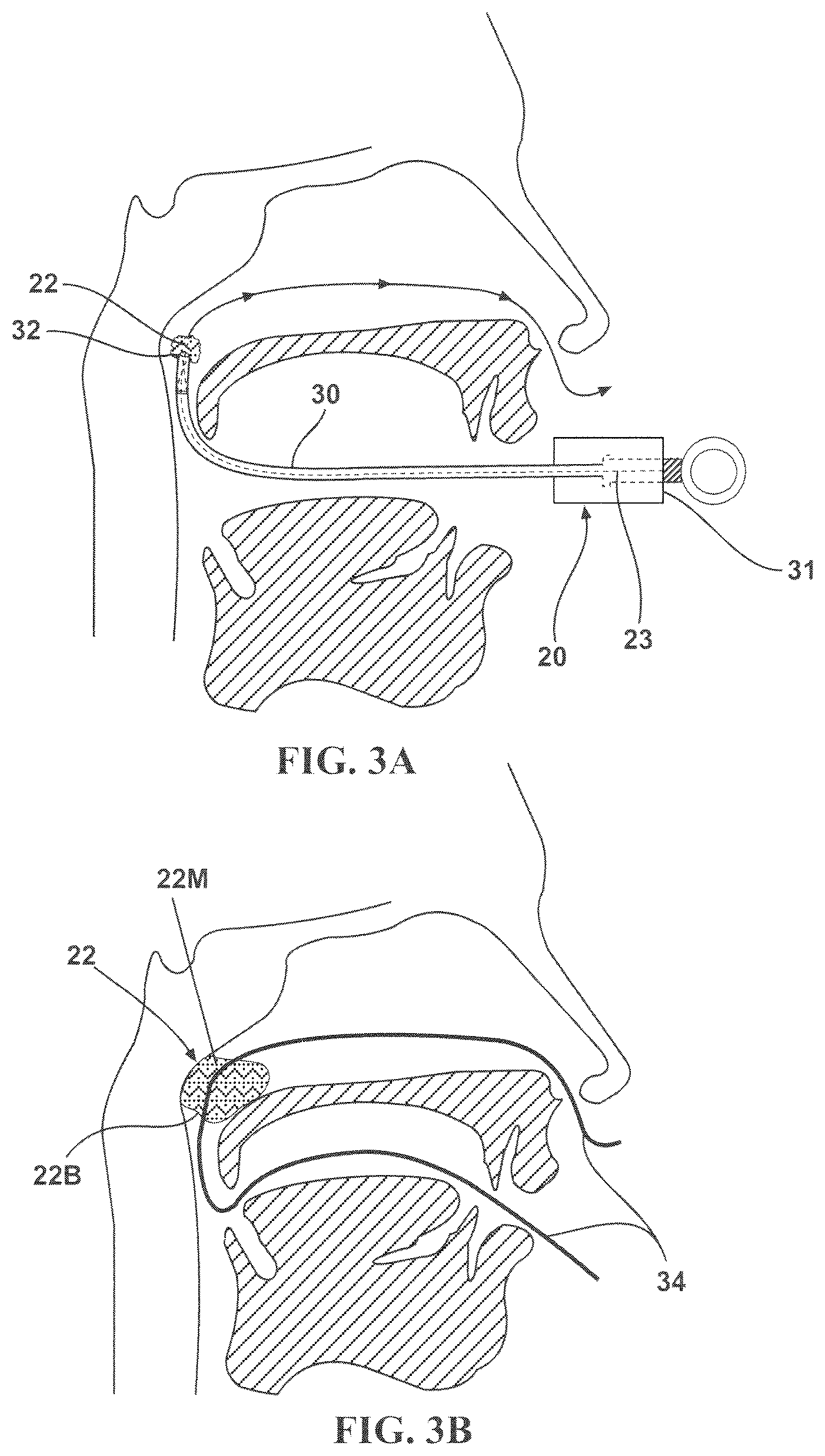 Patent US12551674 Figure 4 – Repositionable surgical tampon