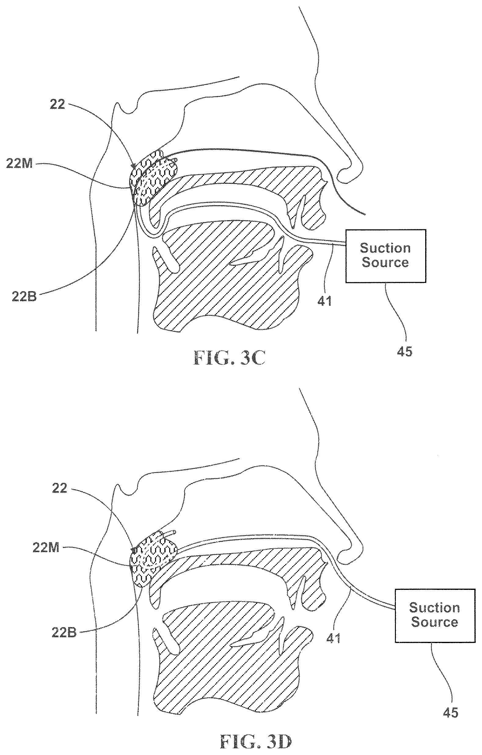 Patent US12551674 Figure 5 – Repositionable surgical tampon