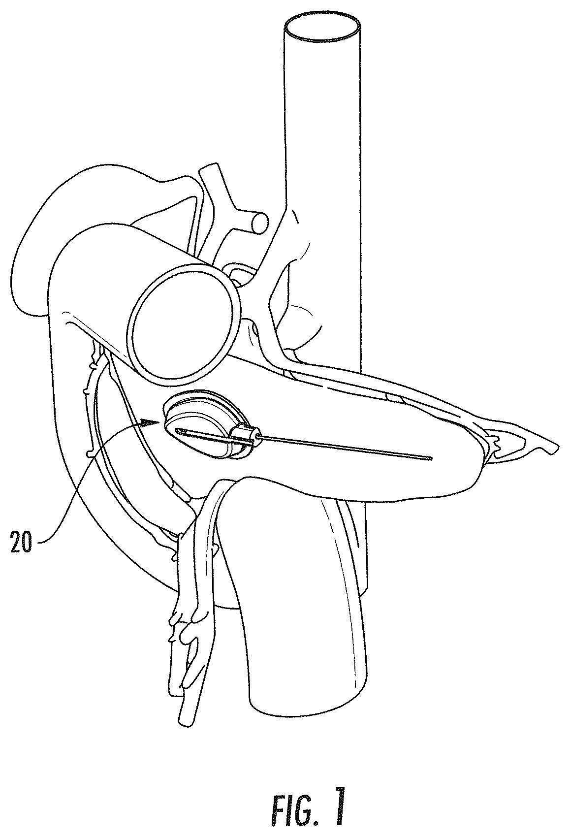 Patent US12551691 Figure 1 – Implantable reservoir for use with a medical device and system for interventional drug delivery