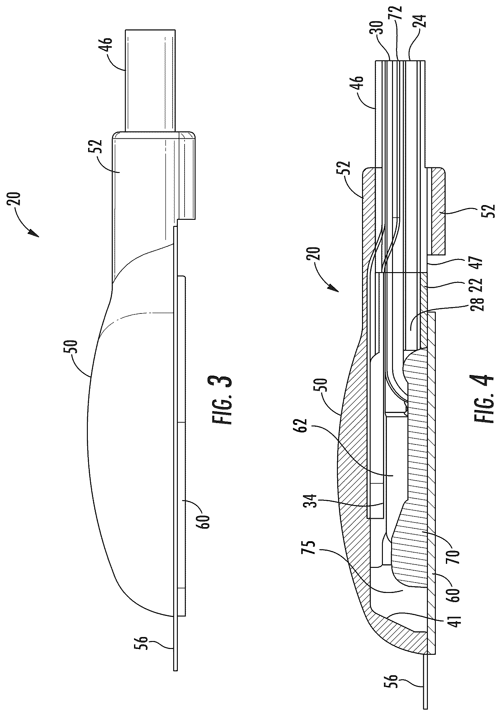 Patent US12551691 Figure 3 – Implantable reservoir for use with a medical device and system for interventional drug delivery