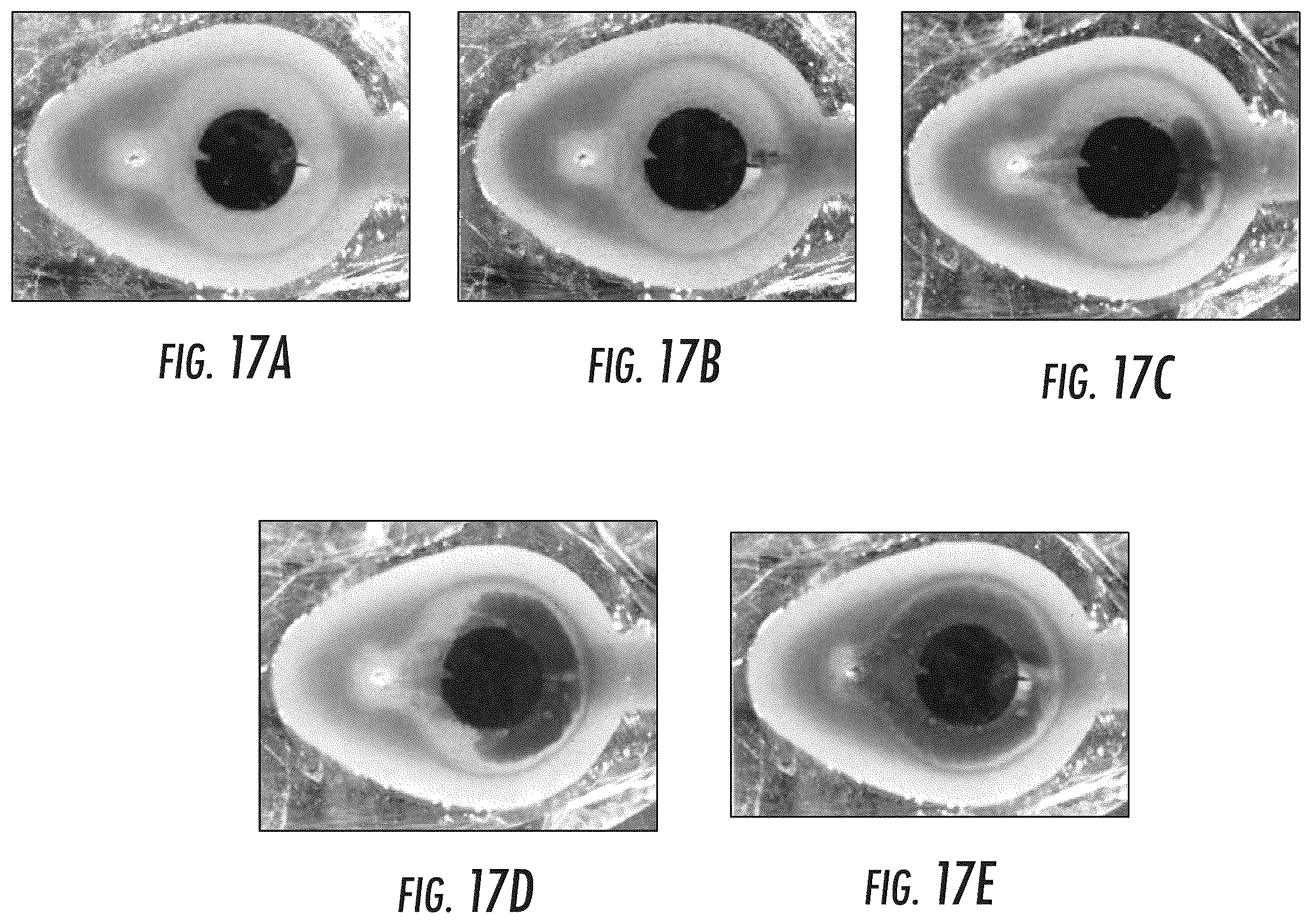 Patent US12551691 Figure 11 – Implantable reservoir for use with a medical device and system for interventional drug delivery