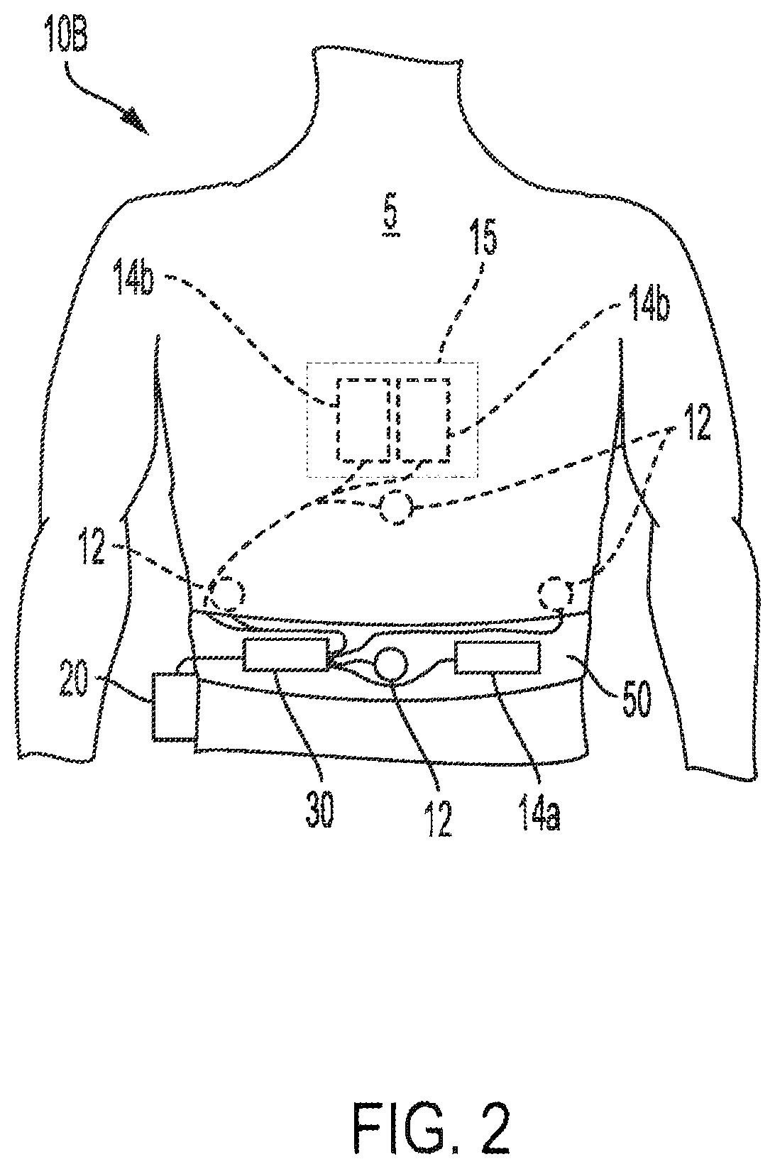 Patent US12551693 Figure 2 – Adhesively coupled wearable medical device