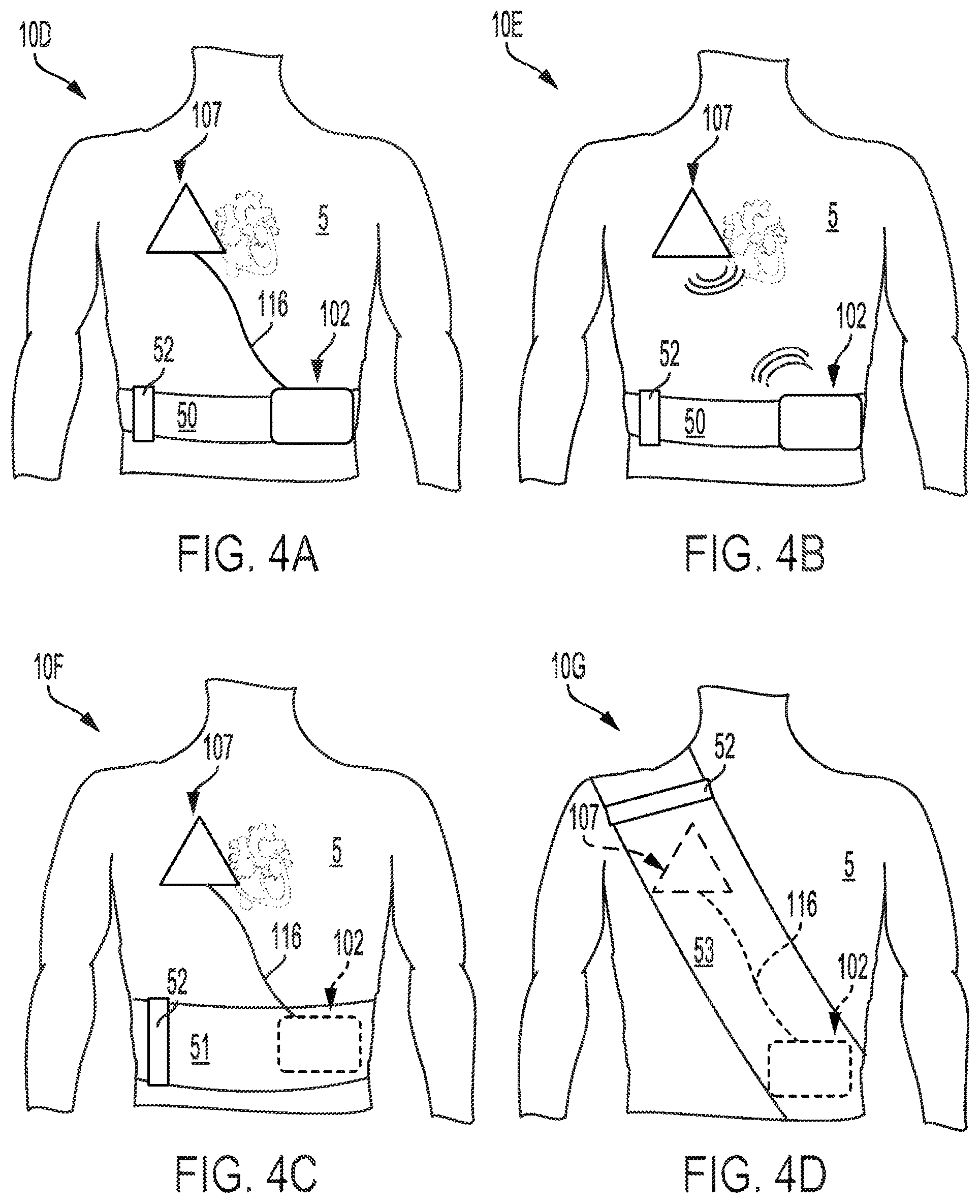 Patent US12551693 Figure 4 – Adhesively coupled wearable medical device