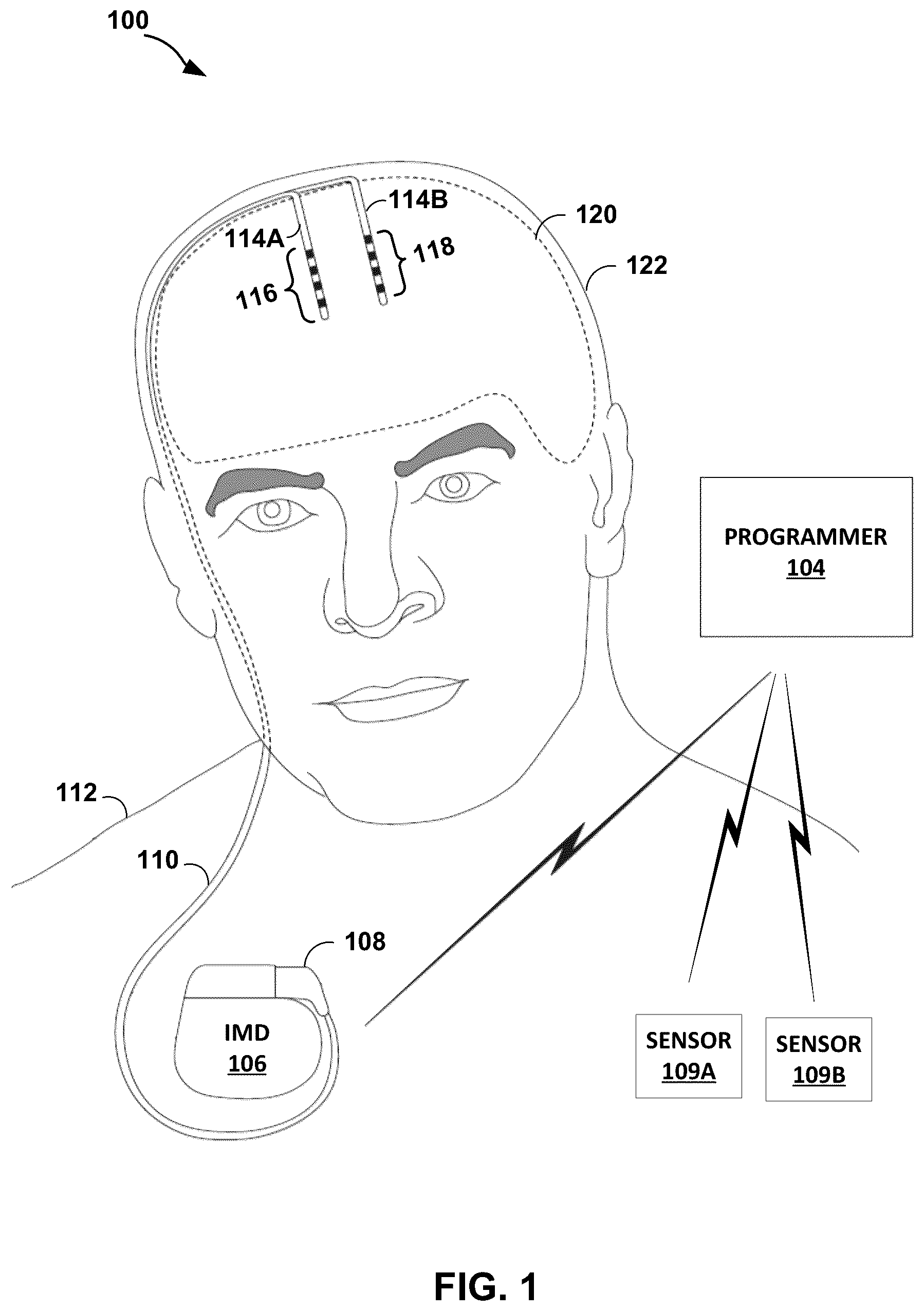 Patent US12551694 — Adaptive deep brain stimulation using homeostatic window — Figure 1