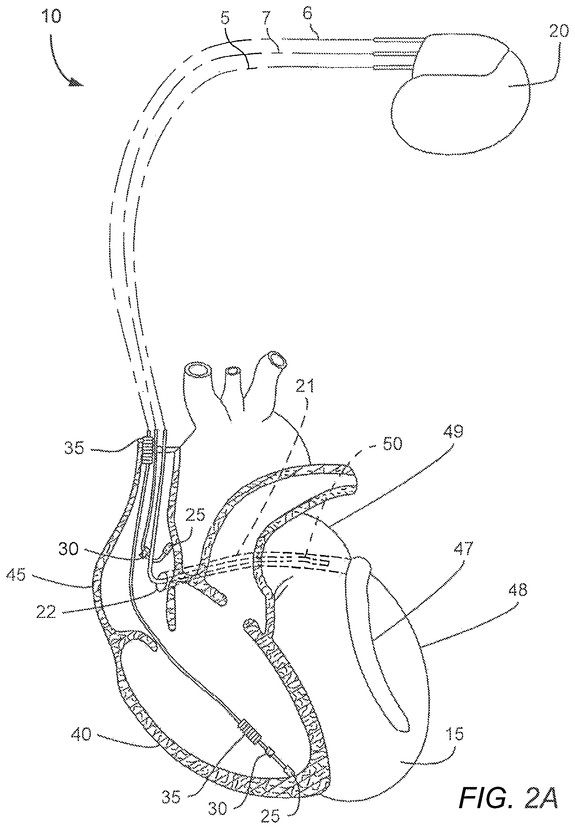 Patent US12551695 Figure 2 – Tube-cut helical fixation anchor for electrotherapy device