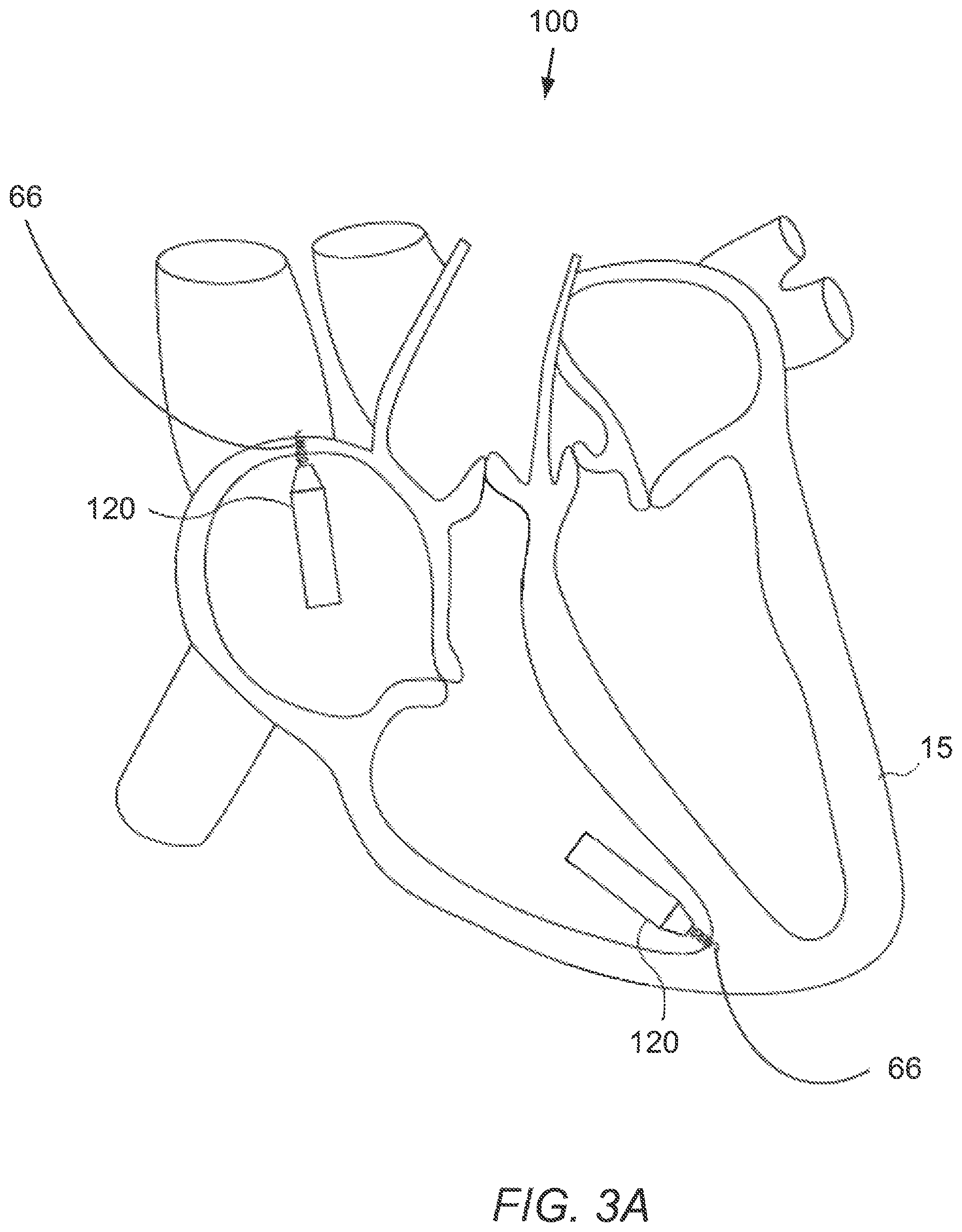 Patent US12551695 Figure 4 – Tube-cut helical fixation anchor for electrotherapy device