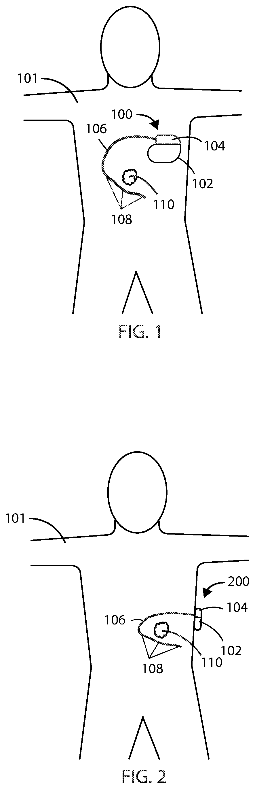 Patent US12551698 Figure 1 – Electrical stimulation with thermal treatment or thermal monitoring