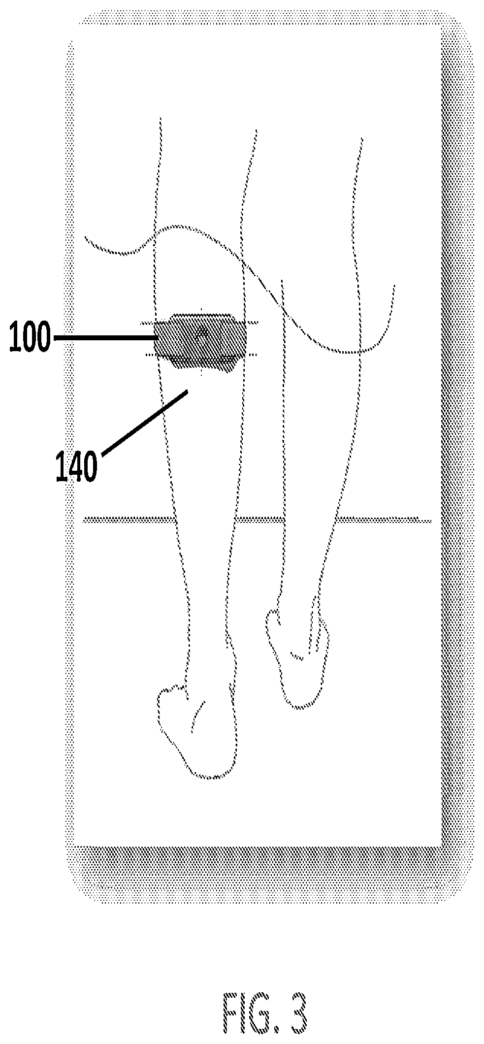 Patent US12551699 Figure 3 – Apparatus and method for relieving pain using transcutaneous electrical nerve stimulation