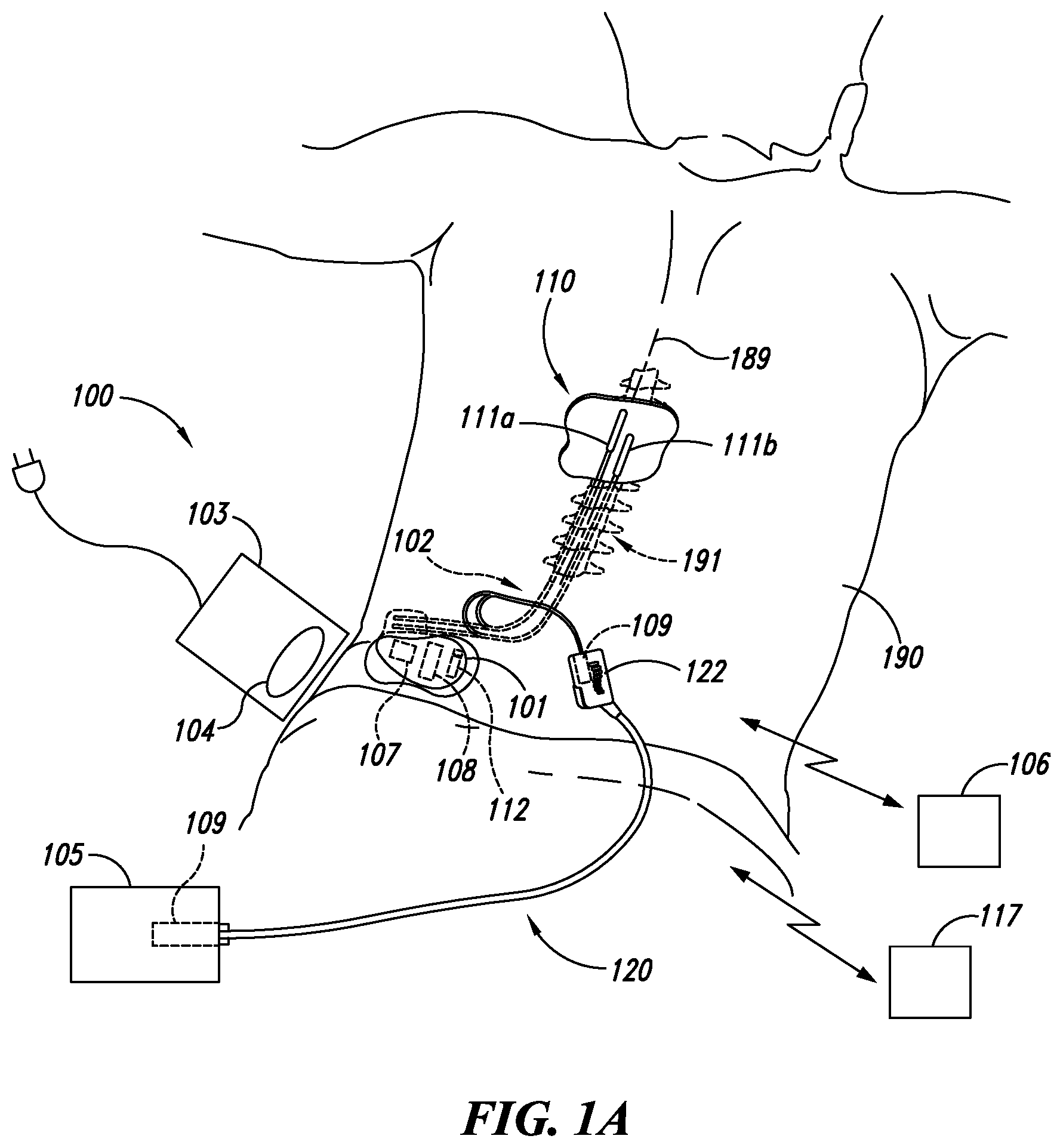 Patent US12551705 — Efficient use of an implantable pulse generator battery, and associated systems and methods — Figure 1