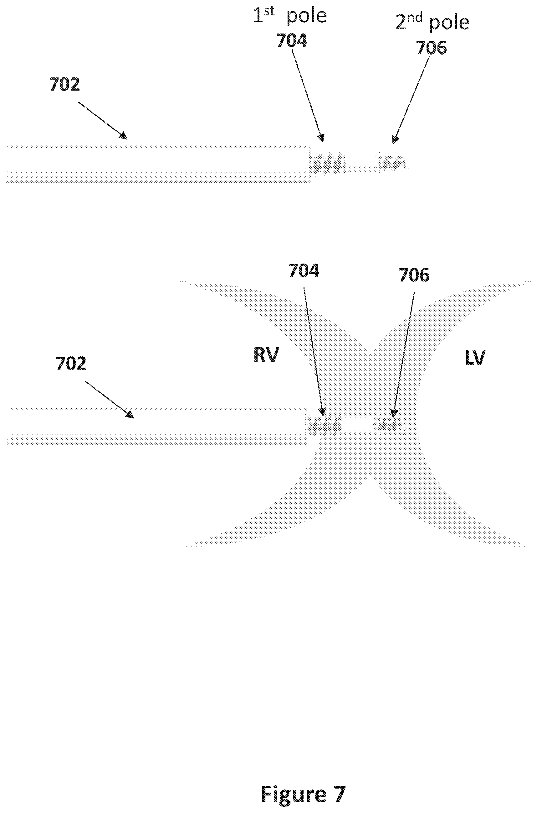Patent US12551707 Figure 7 – Means and methods for using non-excitatory electrical heart failure therapy as a therapy for heart failure with preserved ejection fraction