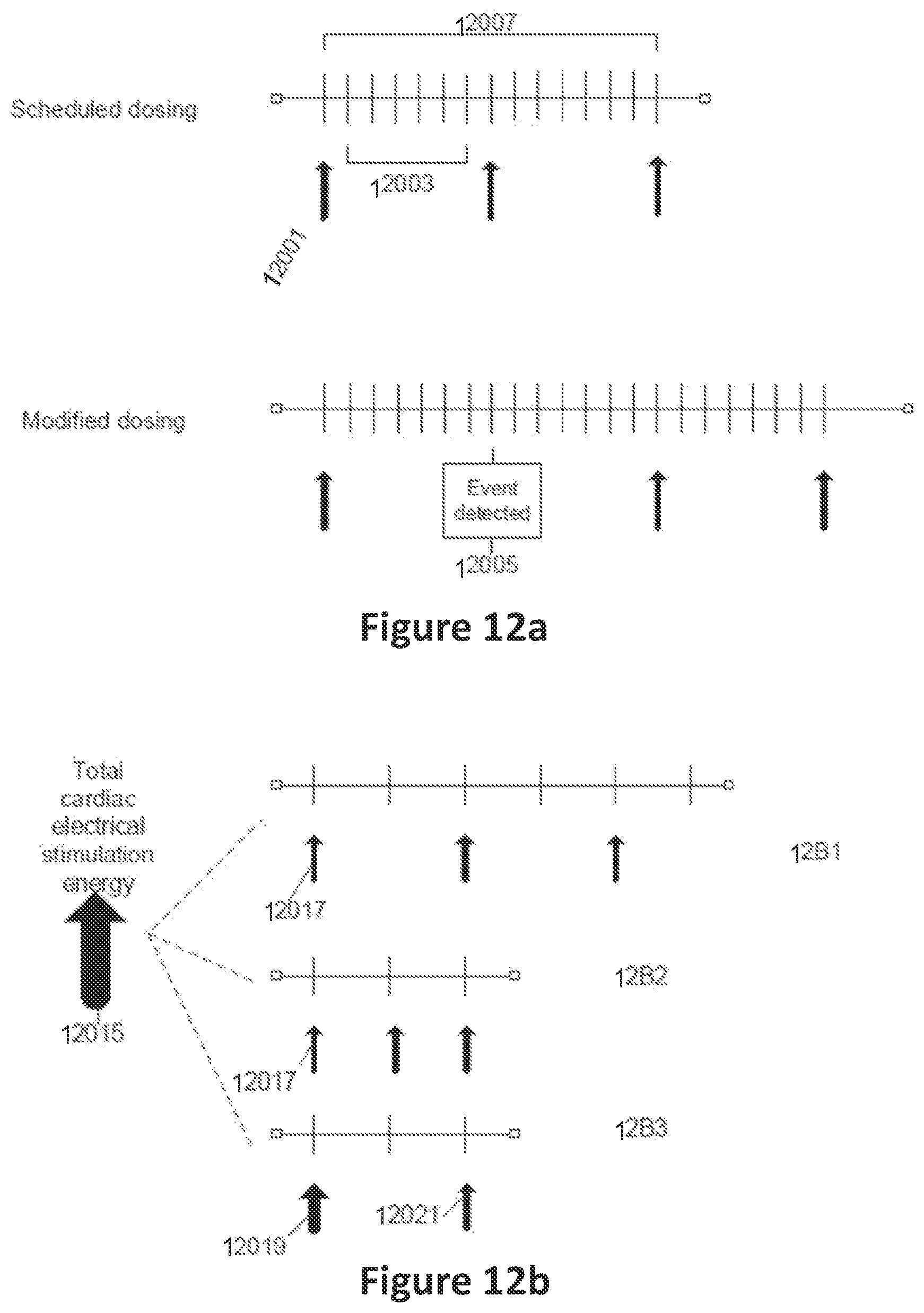Patent US12551707 Figure 12 – Means and methods for using non-excitatory electrical heart failure therapy as a therapy for heart failure with preserved ejection fraction