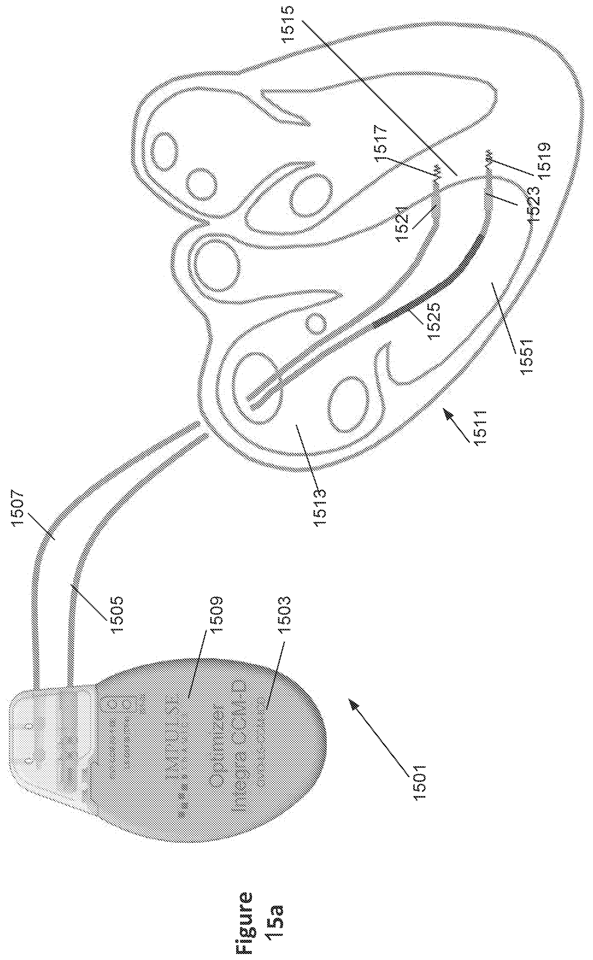 Patent US12551707 Figure 16 – Means and methods for using non-excitatory electrical heart failure therapy as a therapy for heart failure with preserved ejection fraction