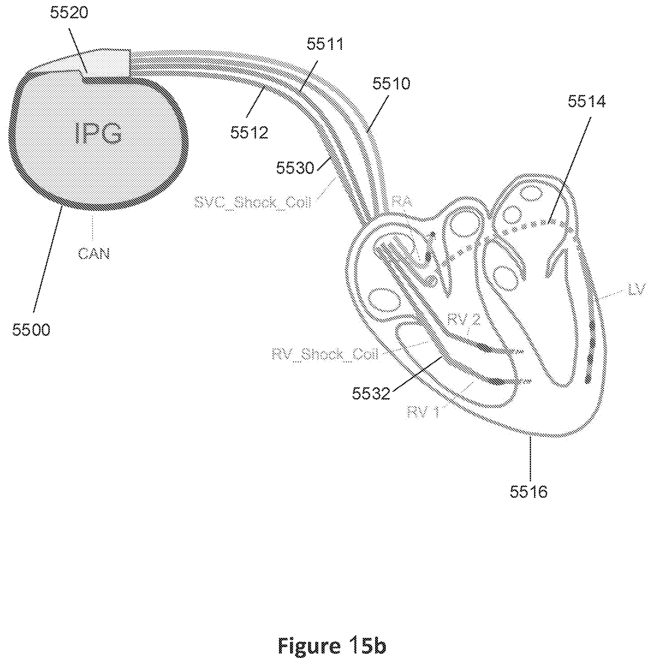 Patent US12551707 Figure 17 – Means and methods for using non-excitatory electrical heart failure therapy as a therapy for heart failure with preserved ejection fraction