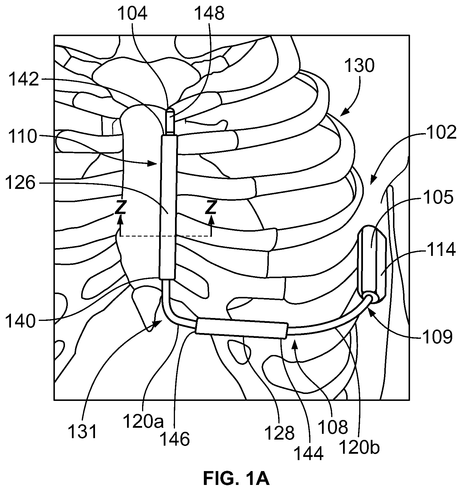 Patent US12551708 Figure 1 – Methods and systems for posture dependent implantable cardioverter defibrillator therapy