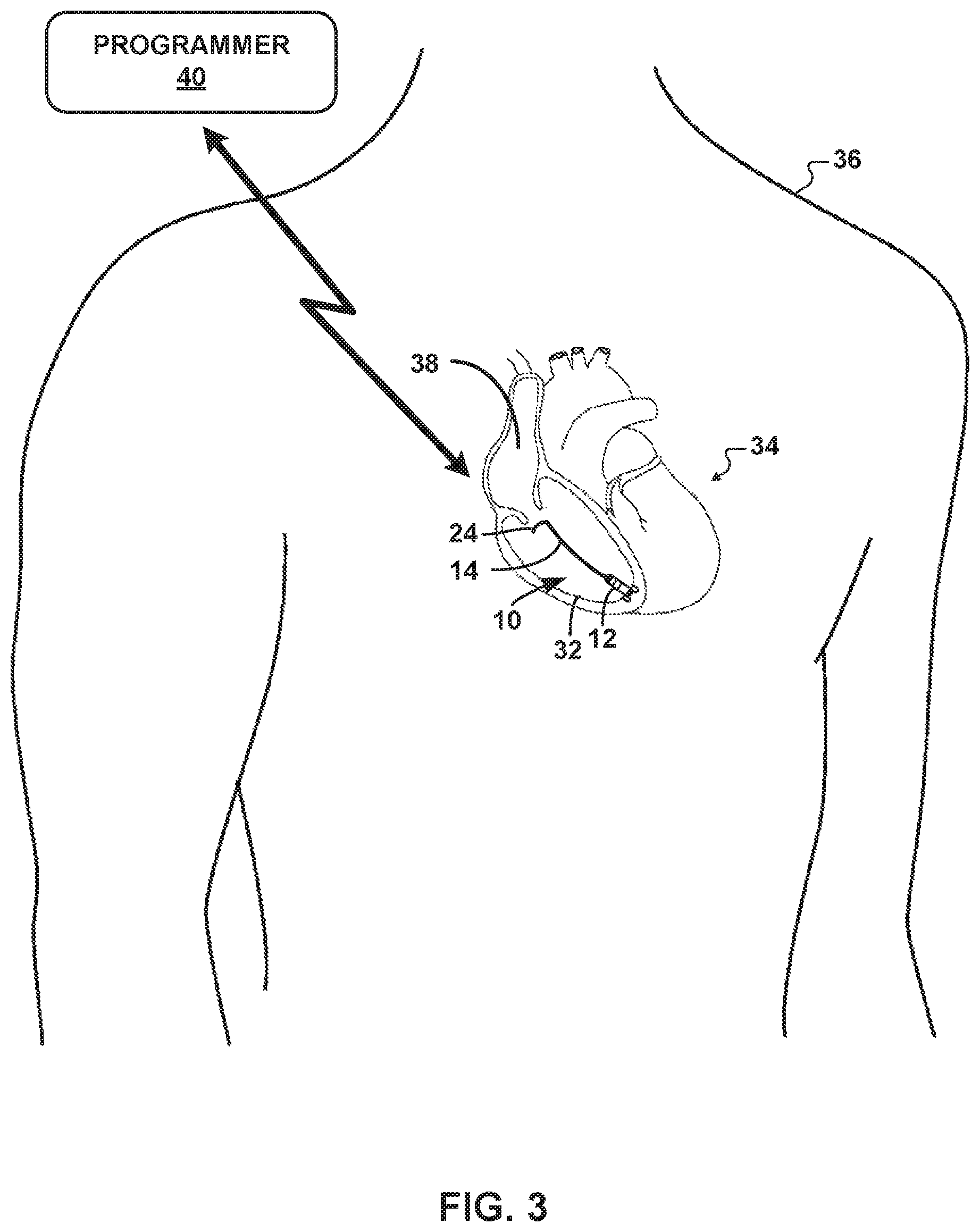 Patent US12551709 Figure 2 – Leadless pacing system including sensing extension