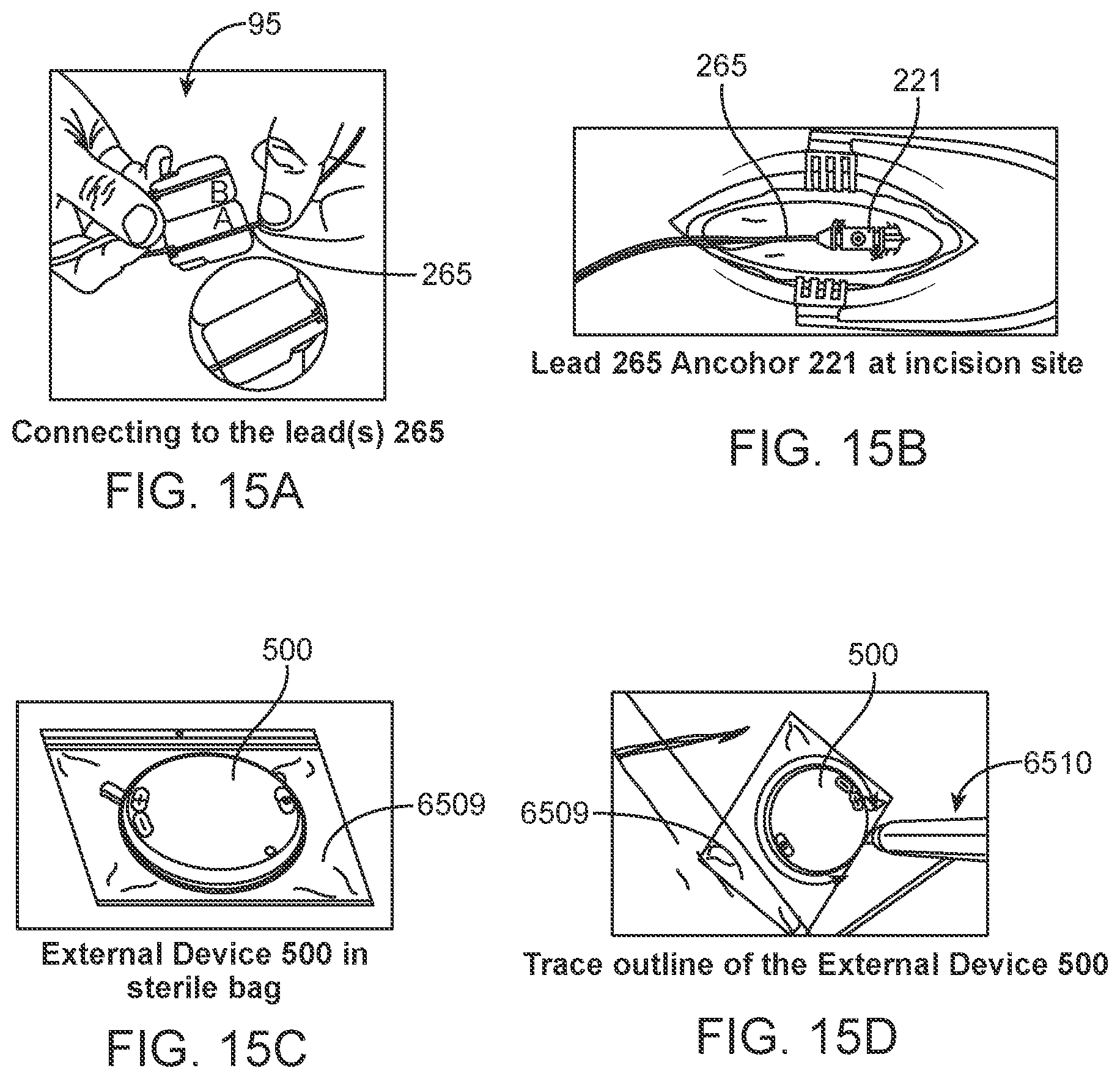 Patent US12551710 Figure 17 – Stimulation apparatus