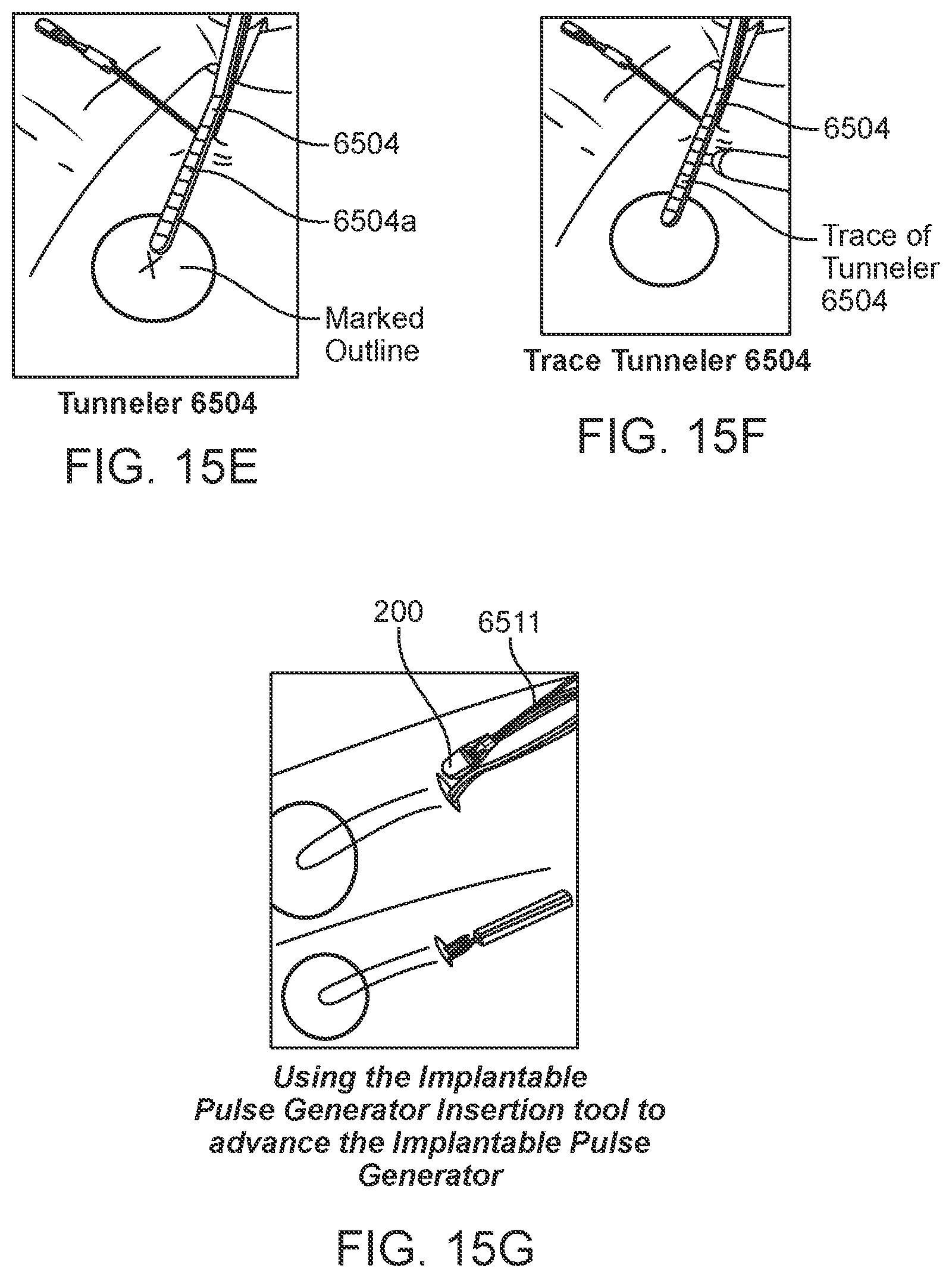 Patent US12551710 Figure 18 – Stimulation apparatus