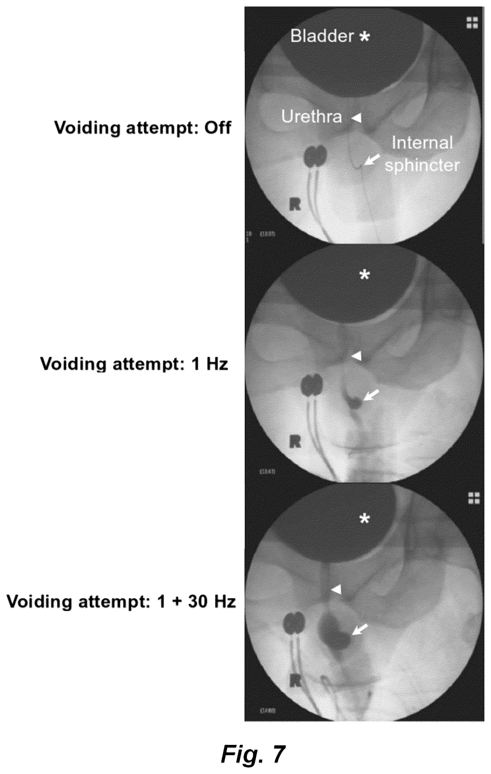Patent US12551714 Figure 7 – Magnetic stimulation of the spinal cord to restore locomotor function and/or control of bladder and bowel