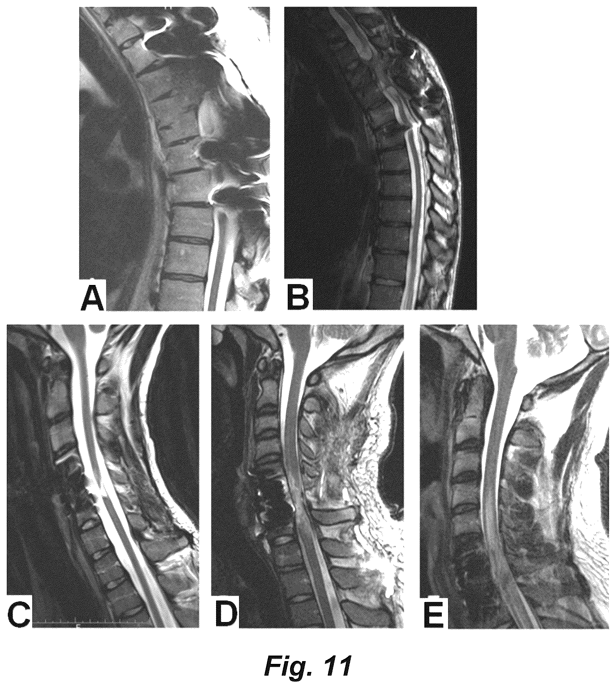 Patent US12551714 Figure 12 – Magnetic stimulation of the spinal cord to restore locomotor function and/or control of bladder and bowel