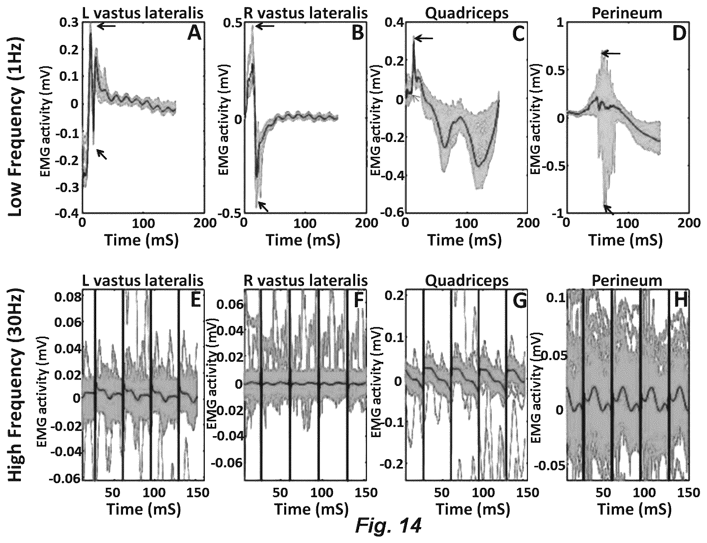 Patent US12551714 Figure 16 – Magnetic stimulation of the spinal cord to restore locomotor function and/or control of bladder and bowel