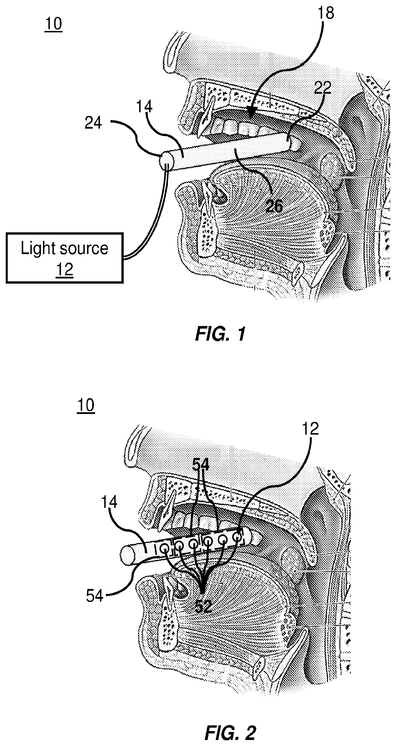 Patent US12551715 Figure 1 – Intraoral phototherapy probe