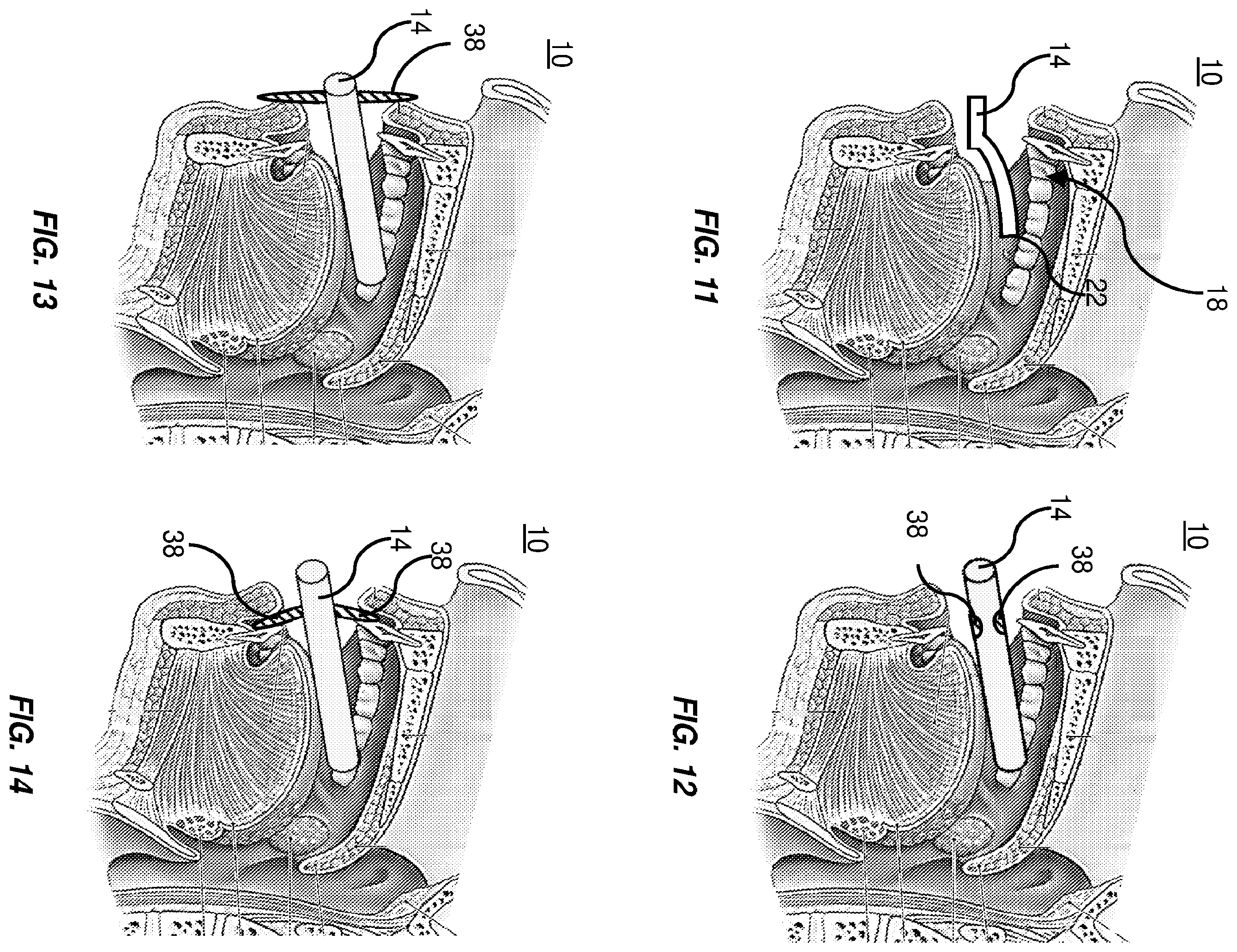 Patent US12551715 Figure 5 – Intraoral phototherapy probe